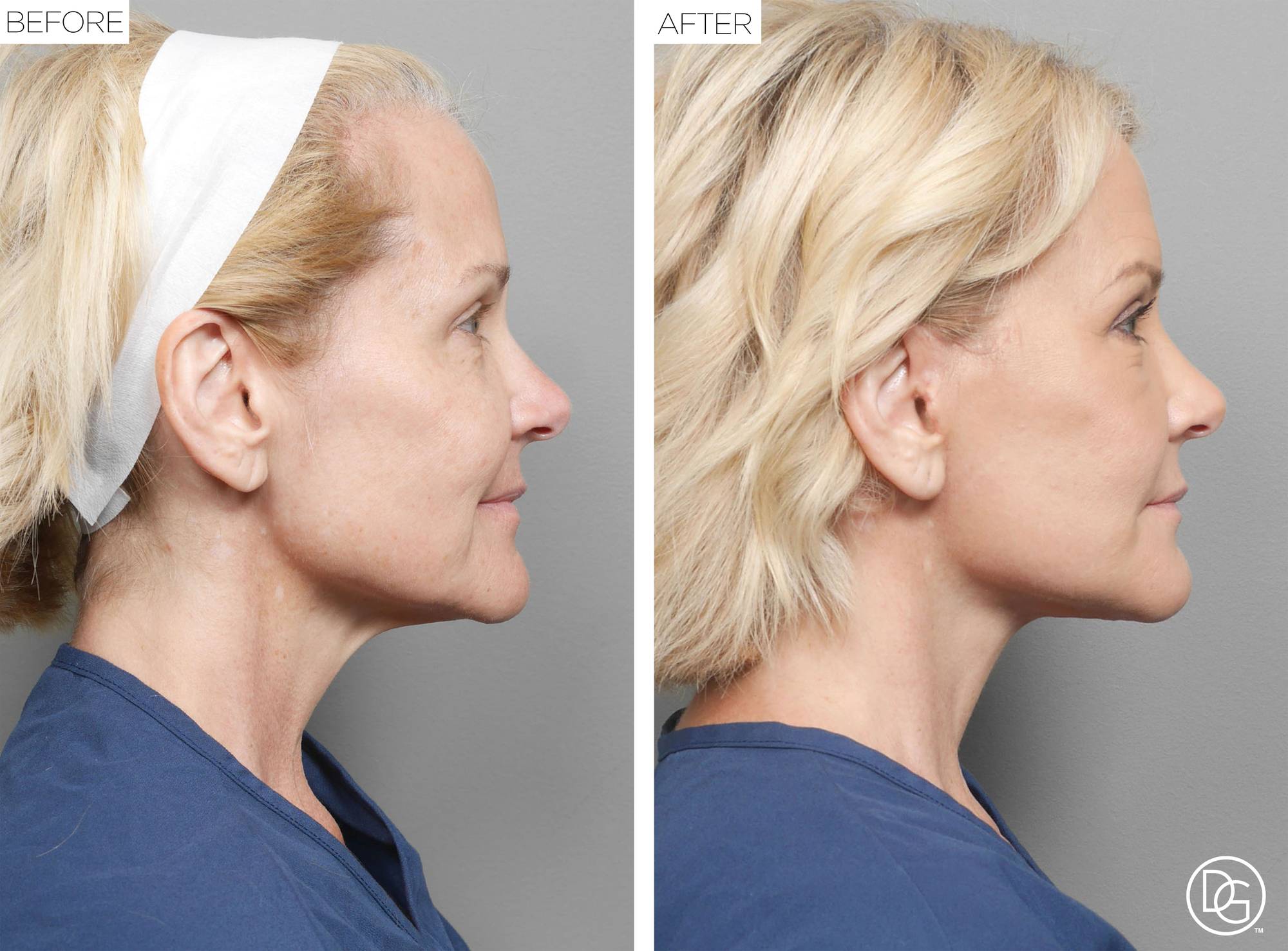 Before & After Image