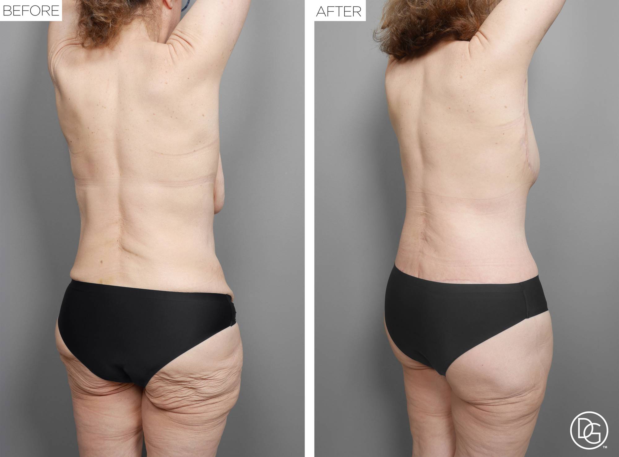 Back Lift Before & After Image