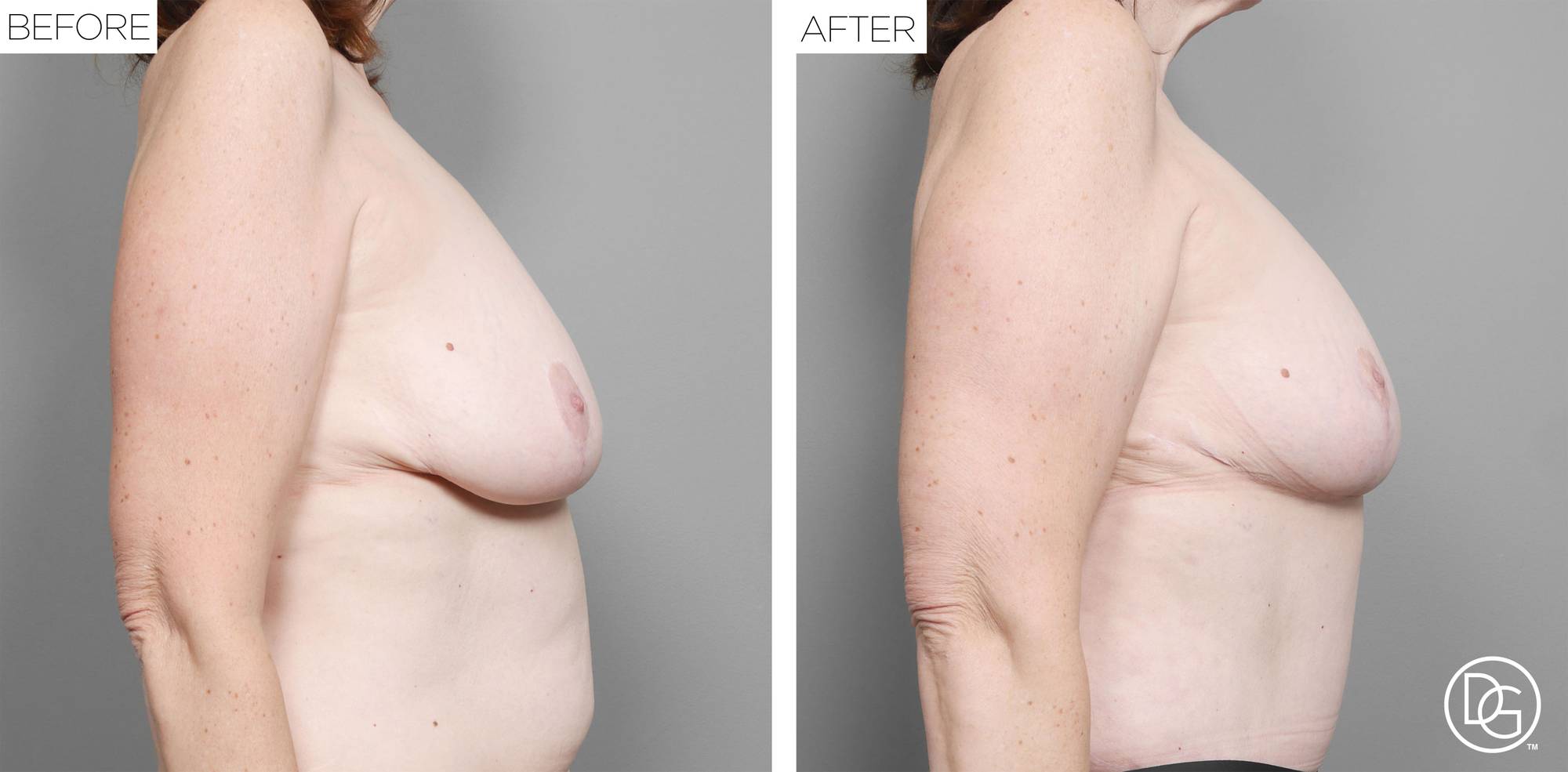 Breast Lift Before & After Image