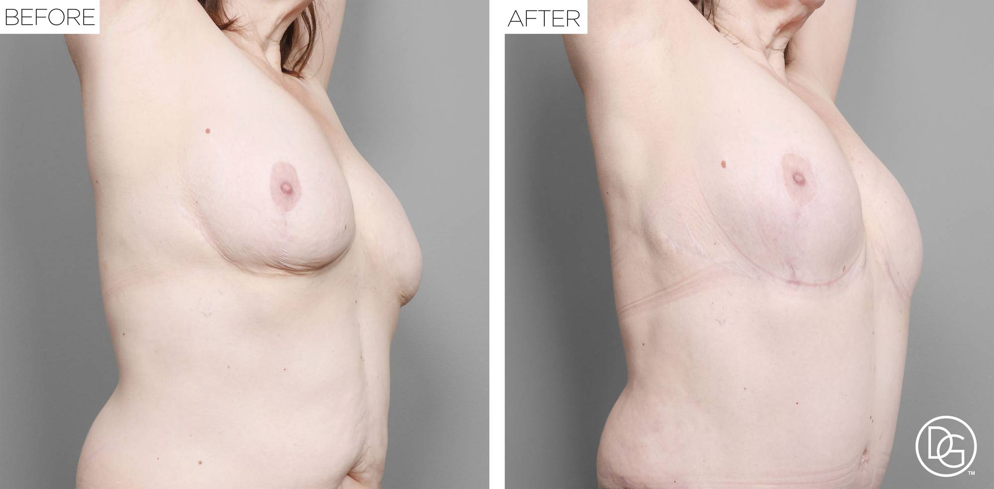 Breast Lift Before & After Image