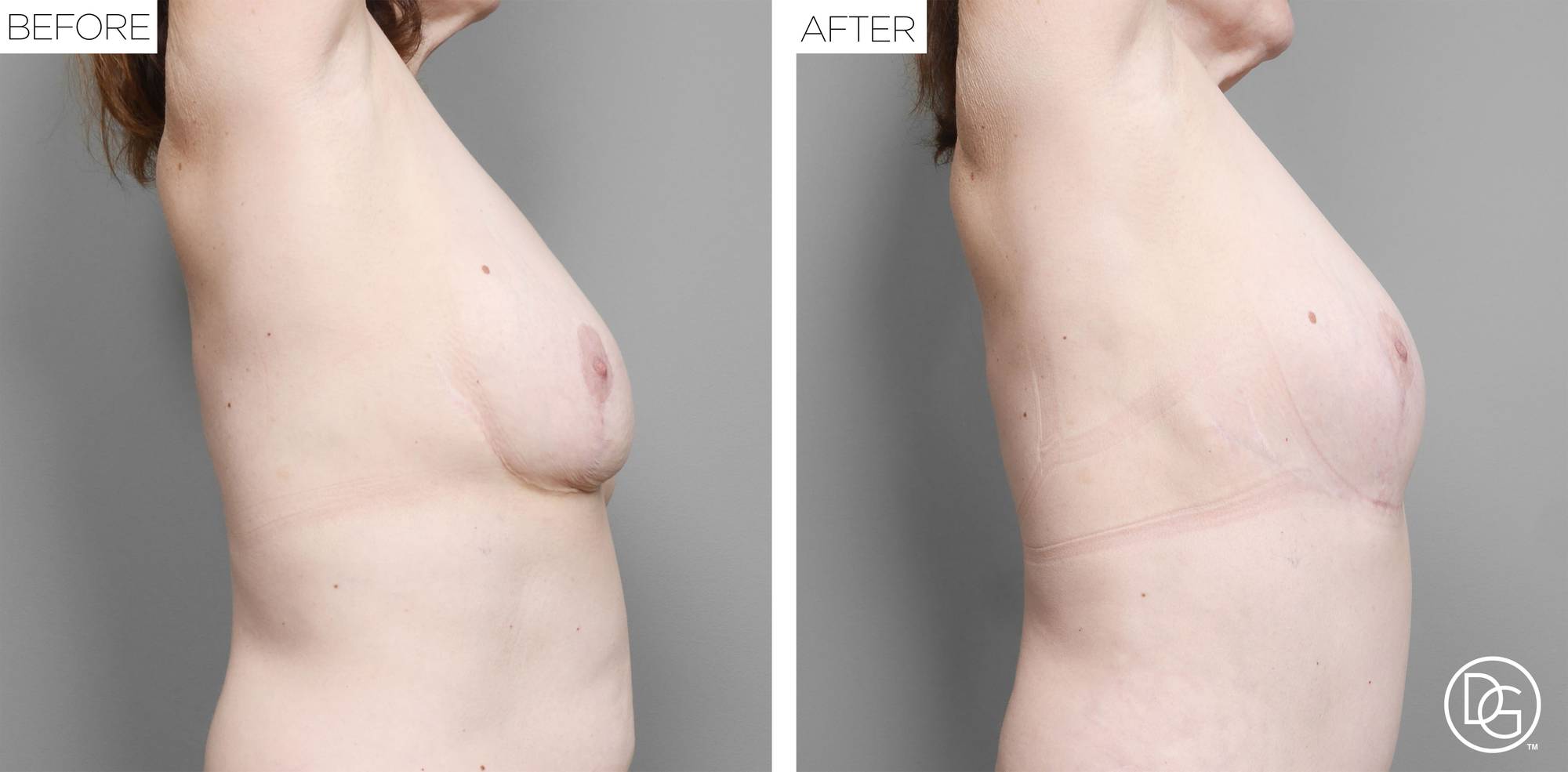 Breast Lift Before & After Image