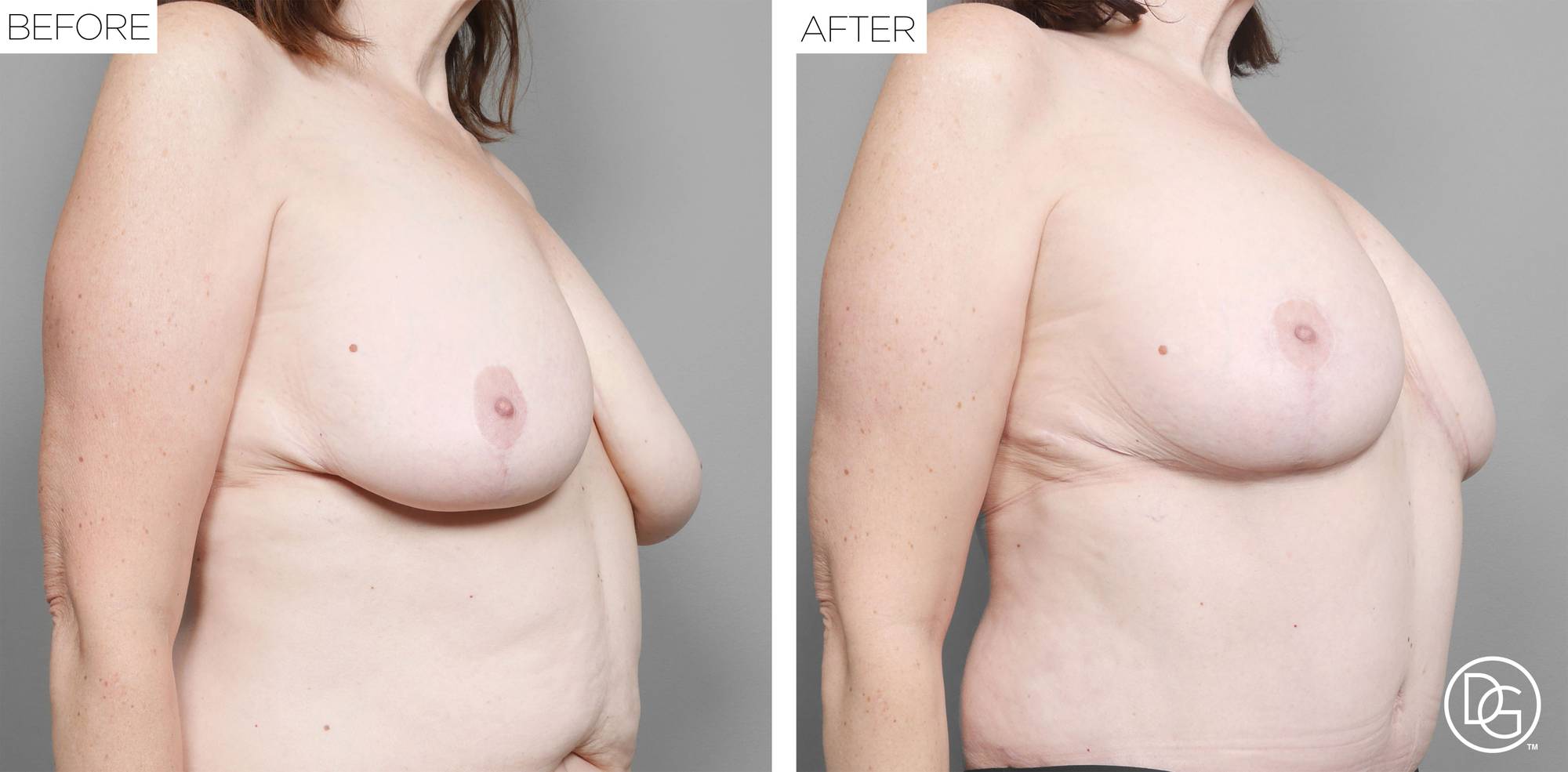 Breast Lift Before & After Image