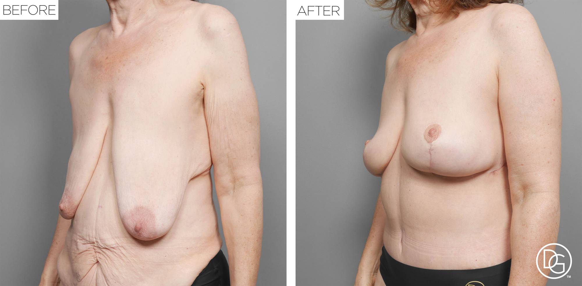 Breast Lift Before & After Image