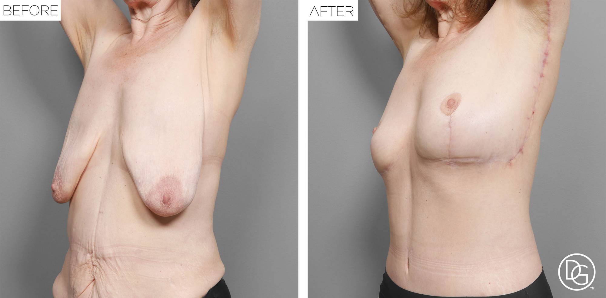 Breast Lift Before & After Image