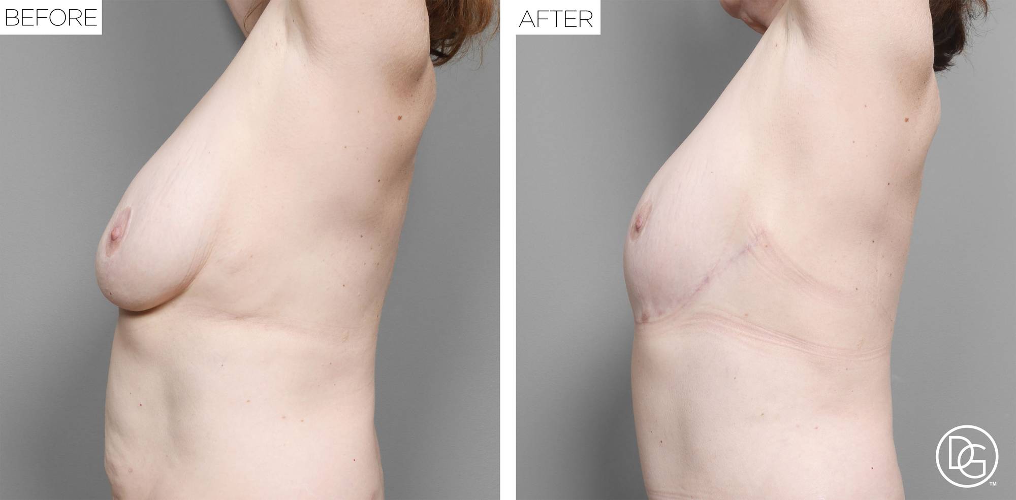 Breast Lift Before & After Image