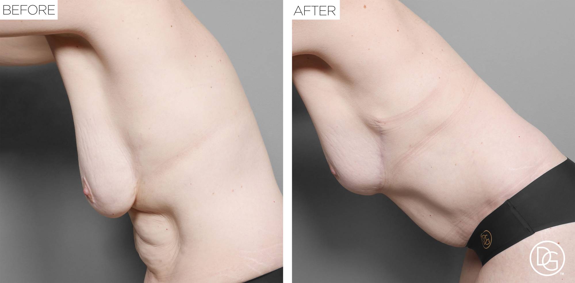 Breast Lift Before & After Image