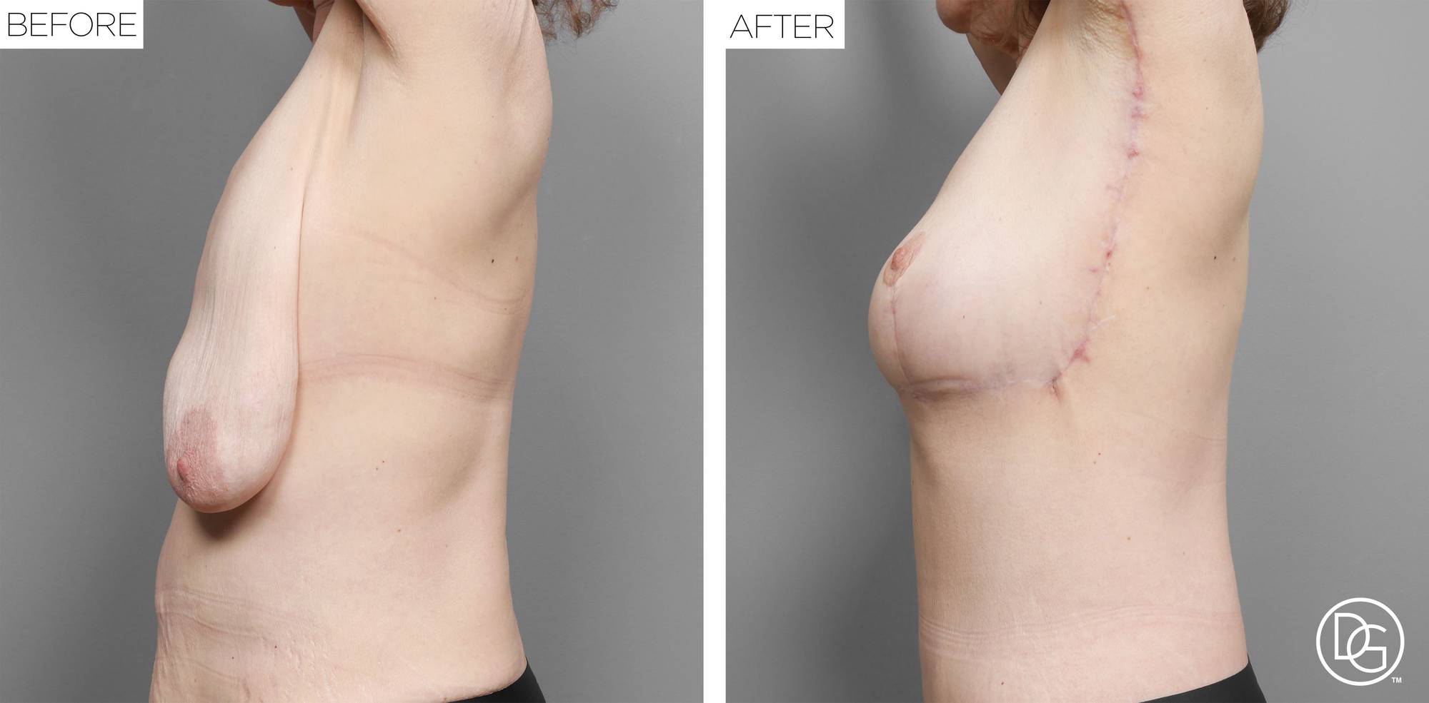 Breast Lift Before & After Image