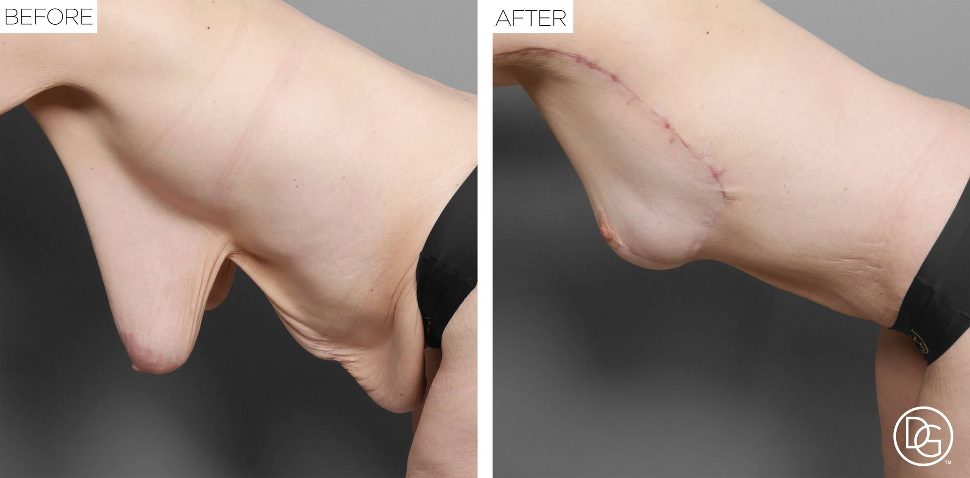 Breast Lift Before & After Image