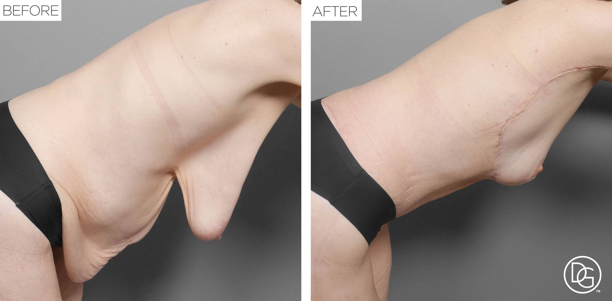 Breast Lift Before & After Image