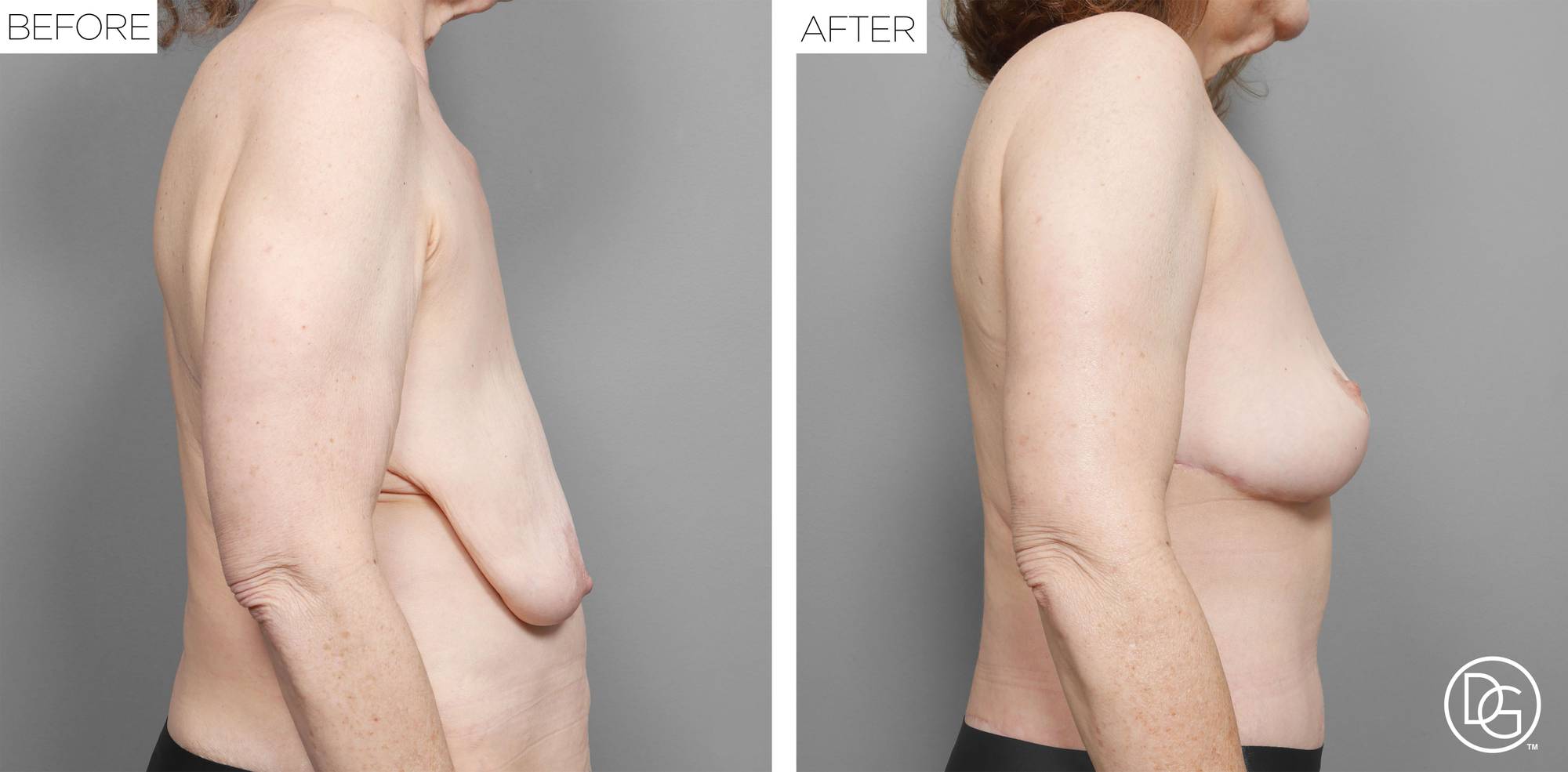 Breast Lift Before & After Image