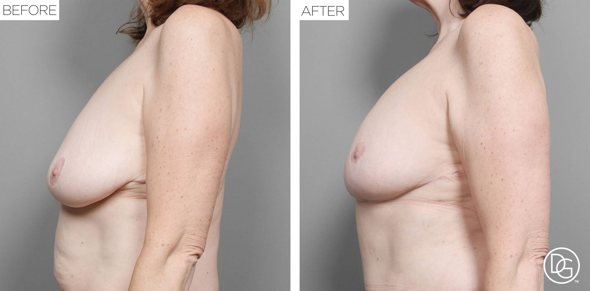 Breast Lift Before & After Image