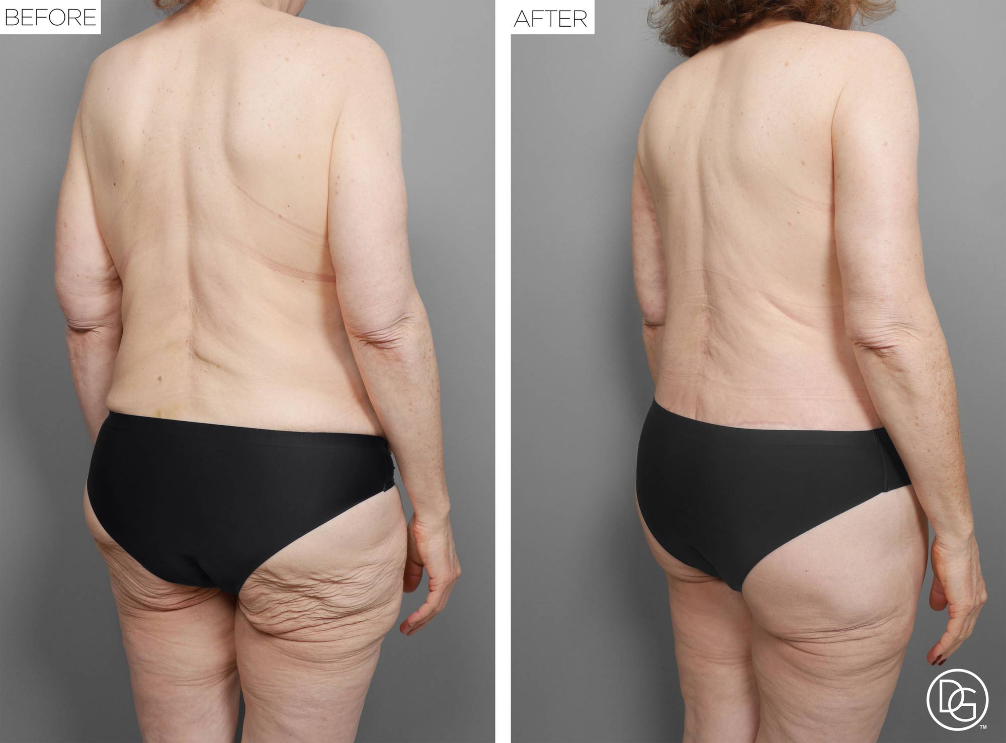 Back Lift Before & After Image