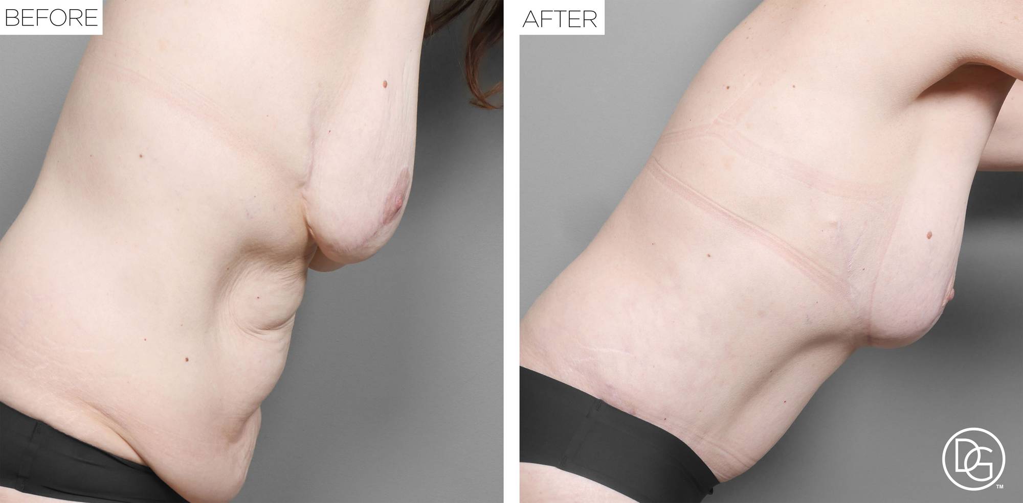 Breast Lift Before & After Image
