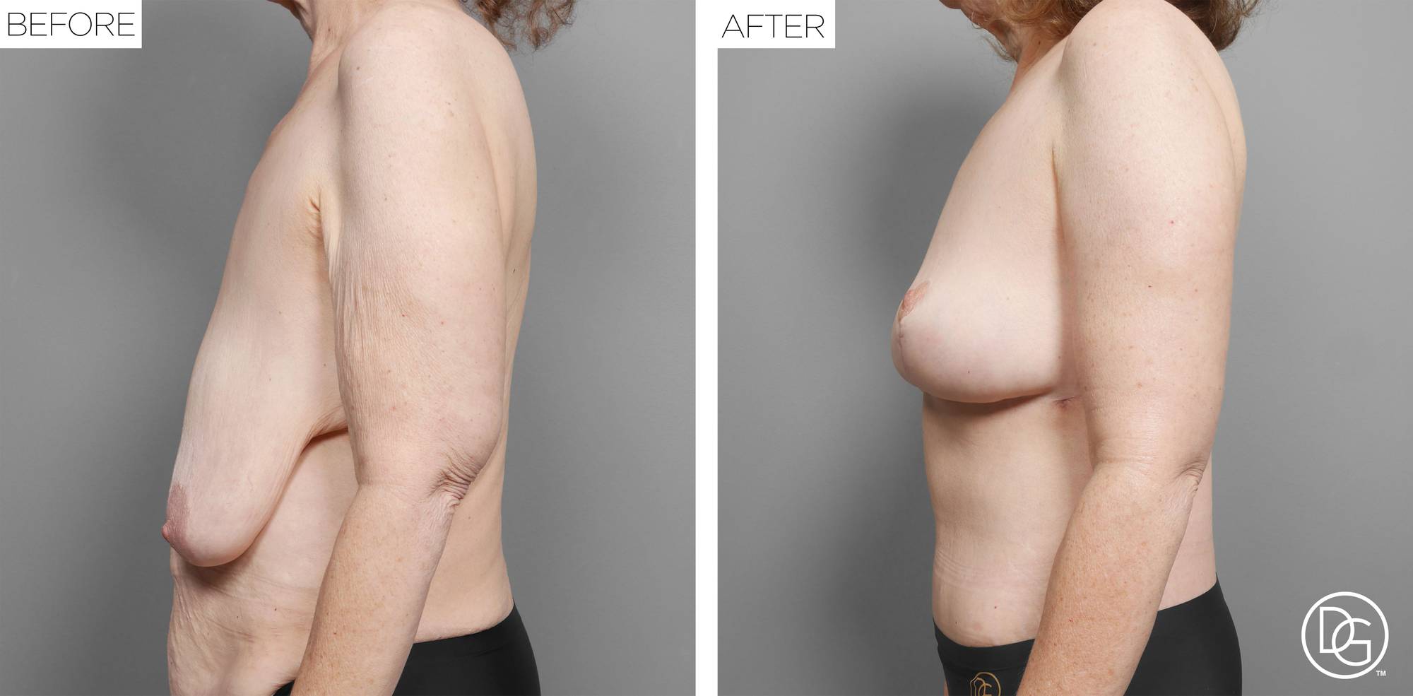 Breast Lift Before & After Image