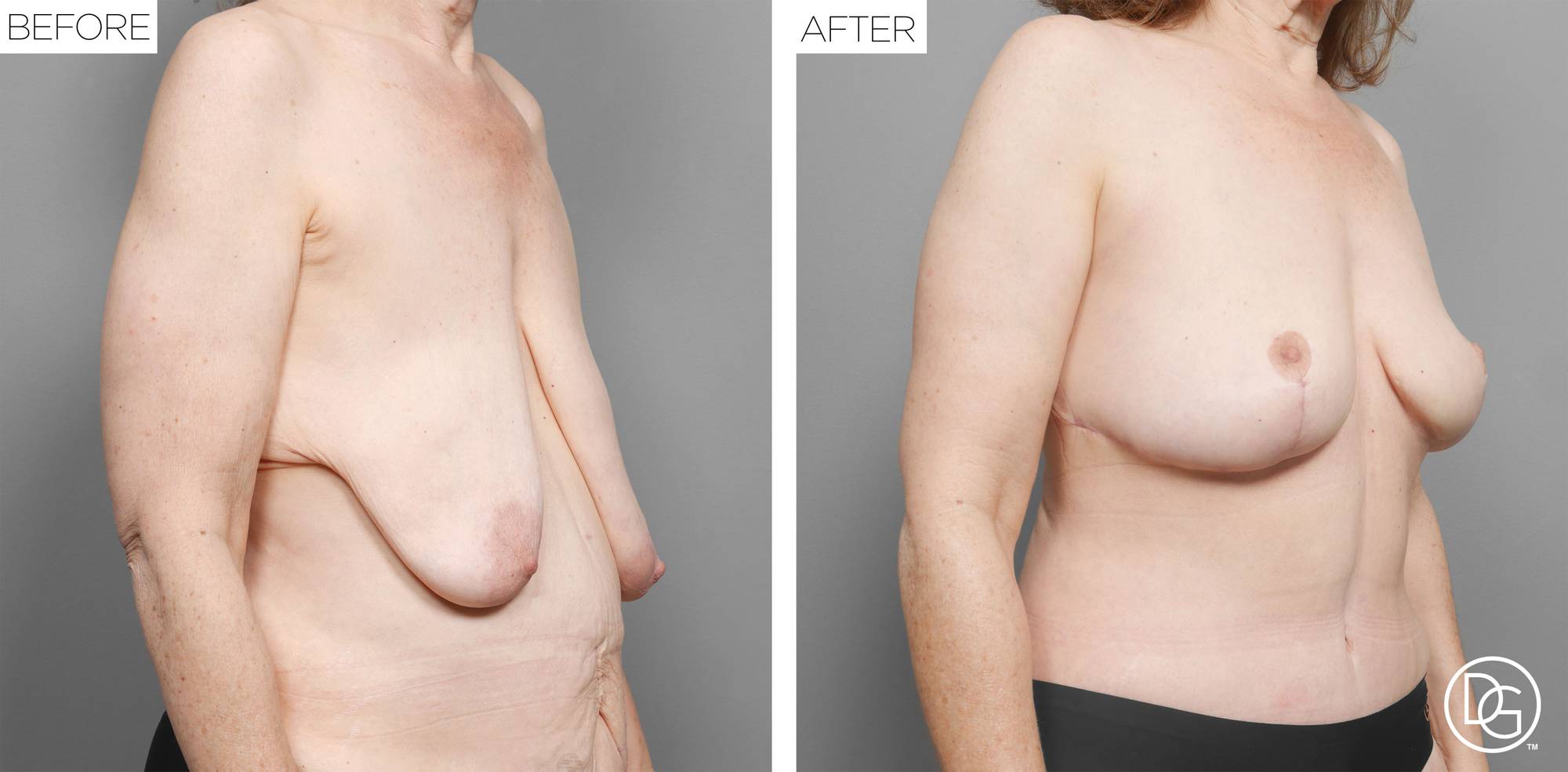 Breast Lift Before & After Image