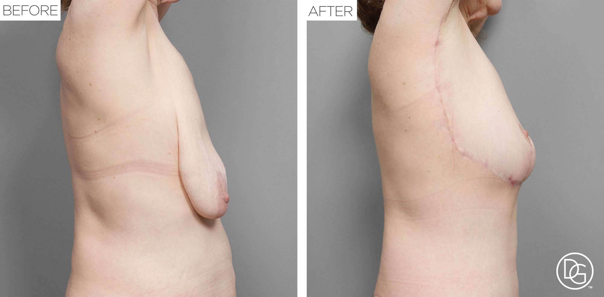 Breast Lift Before & After Image