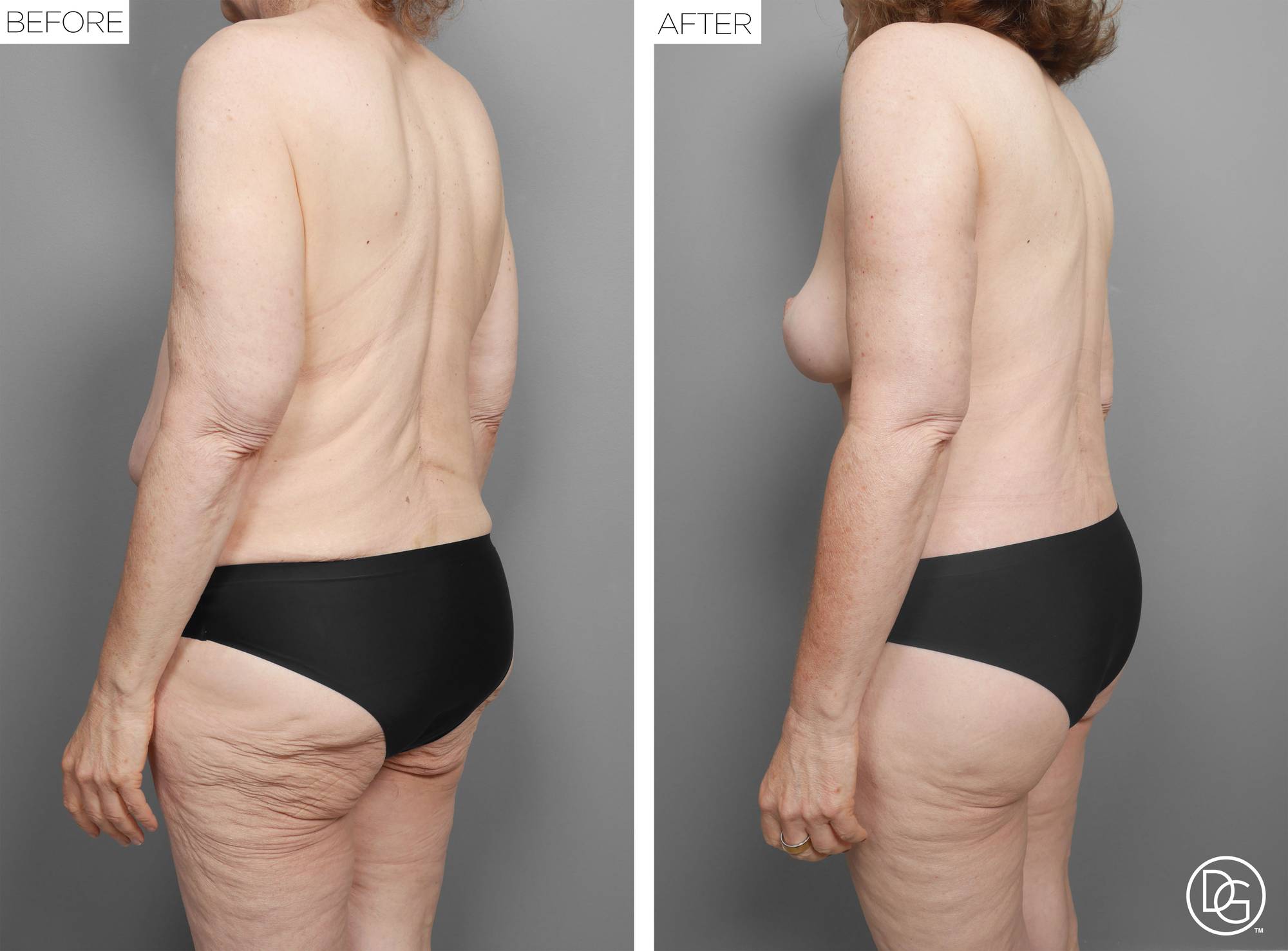 Back Lift Before & After Image