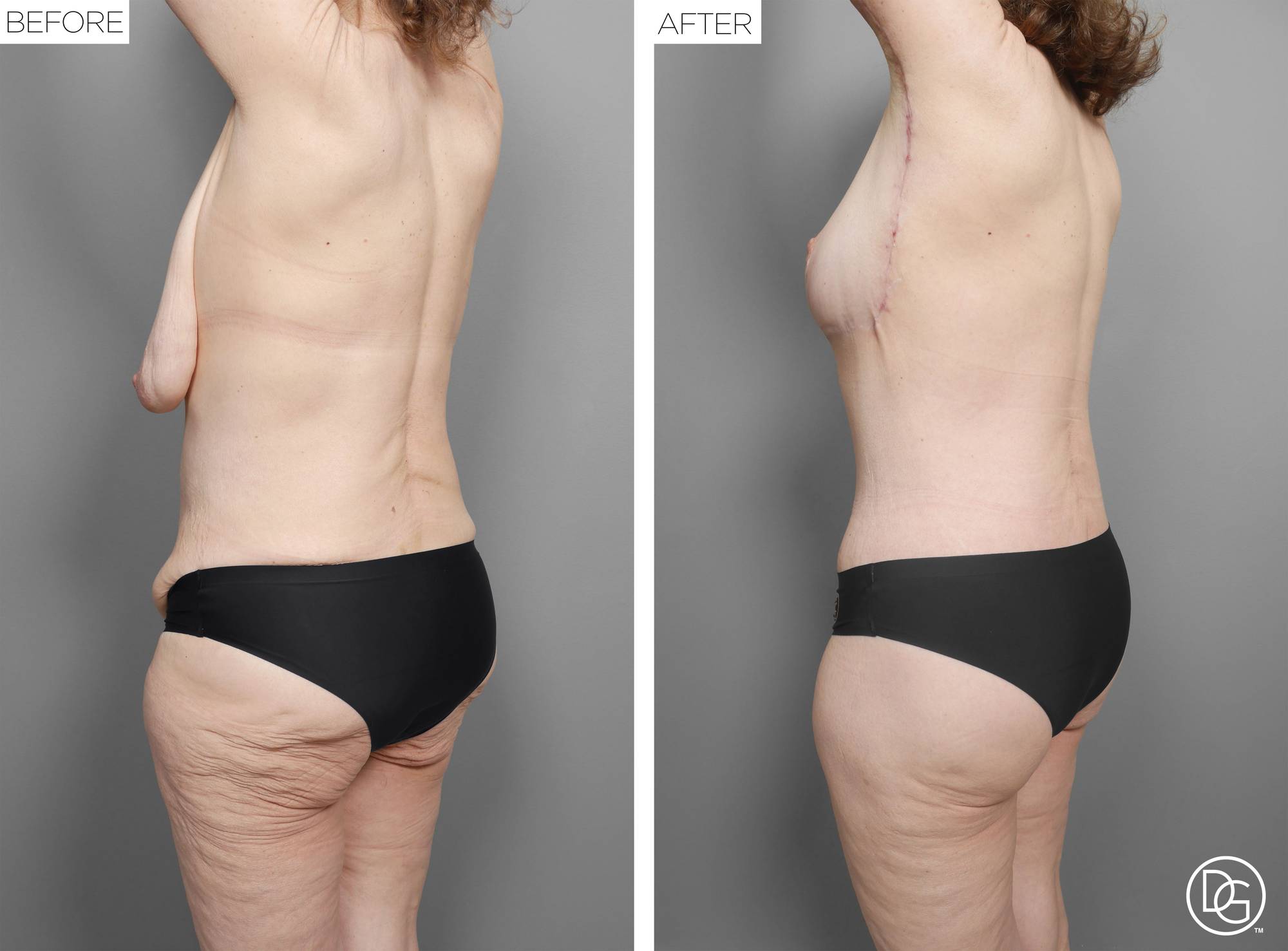 Back Lift Before & After Image