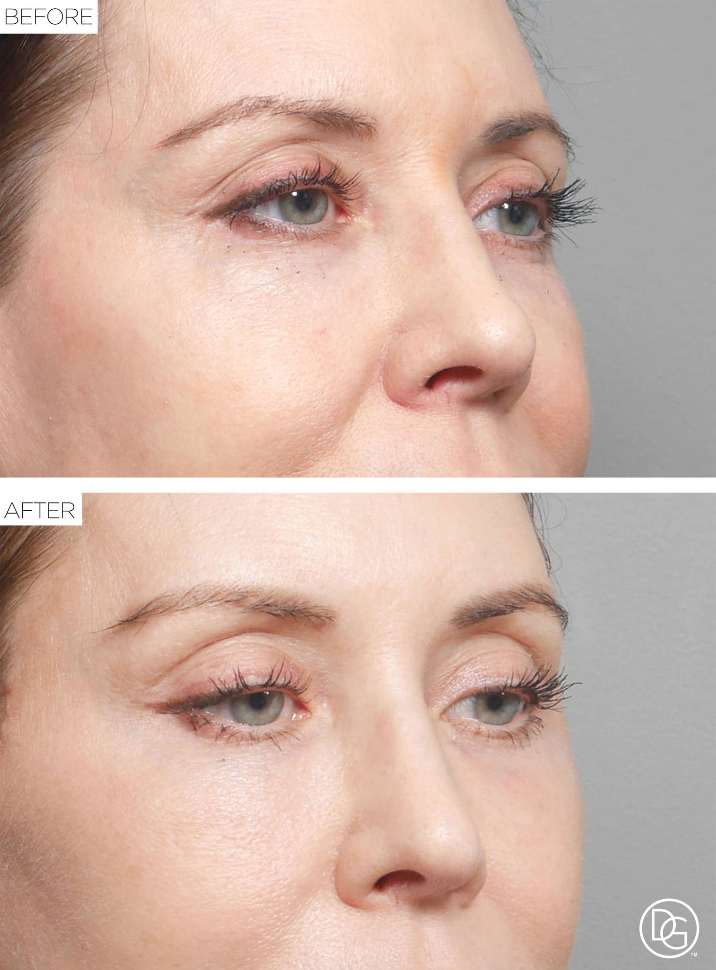 Brow Lift Before & After Image