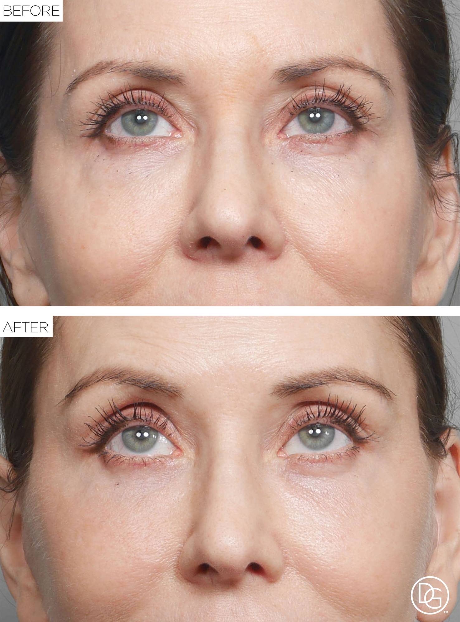 Brow Lift Before & After Image