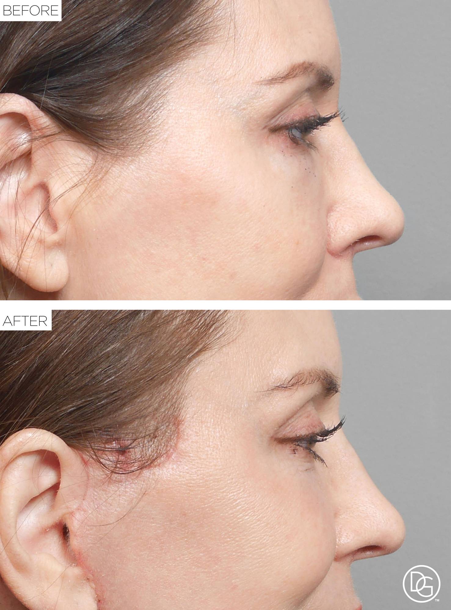 Brow Lift Before & After Image