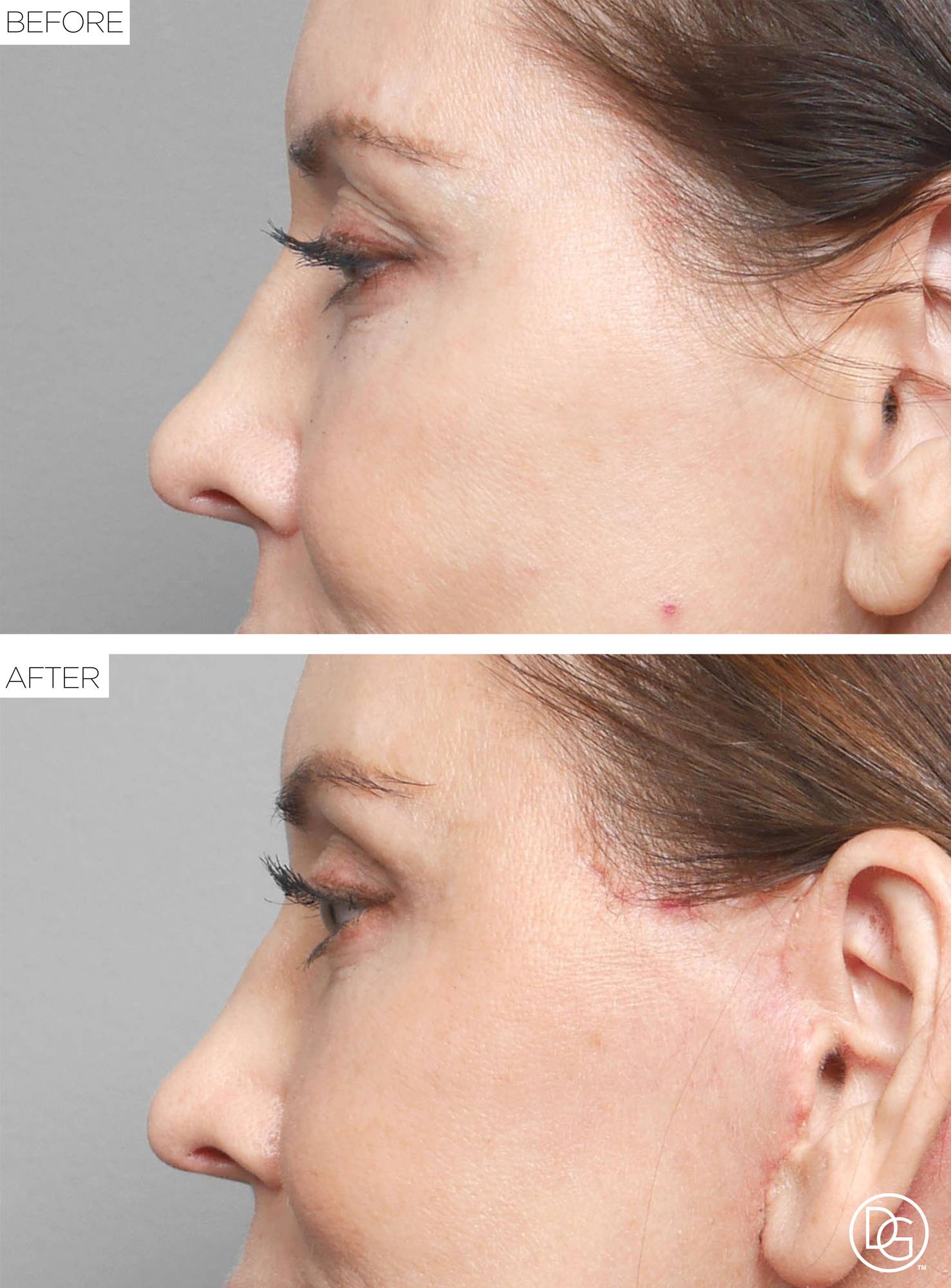 Brow Lift Before & After Image