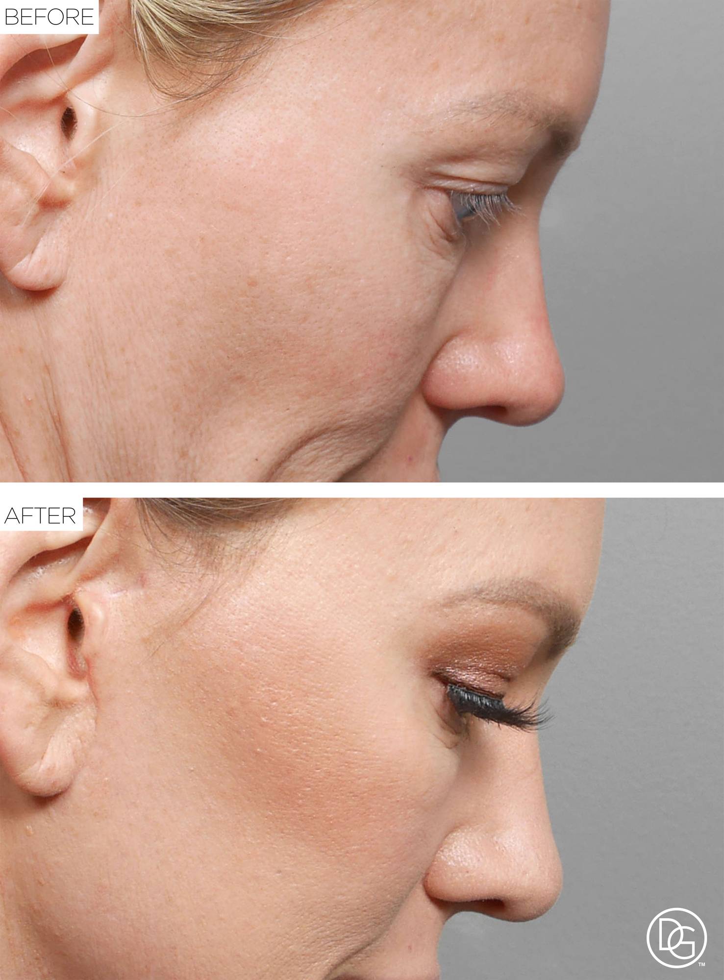 Blepharoplasty Before & After Image