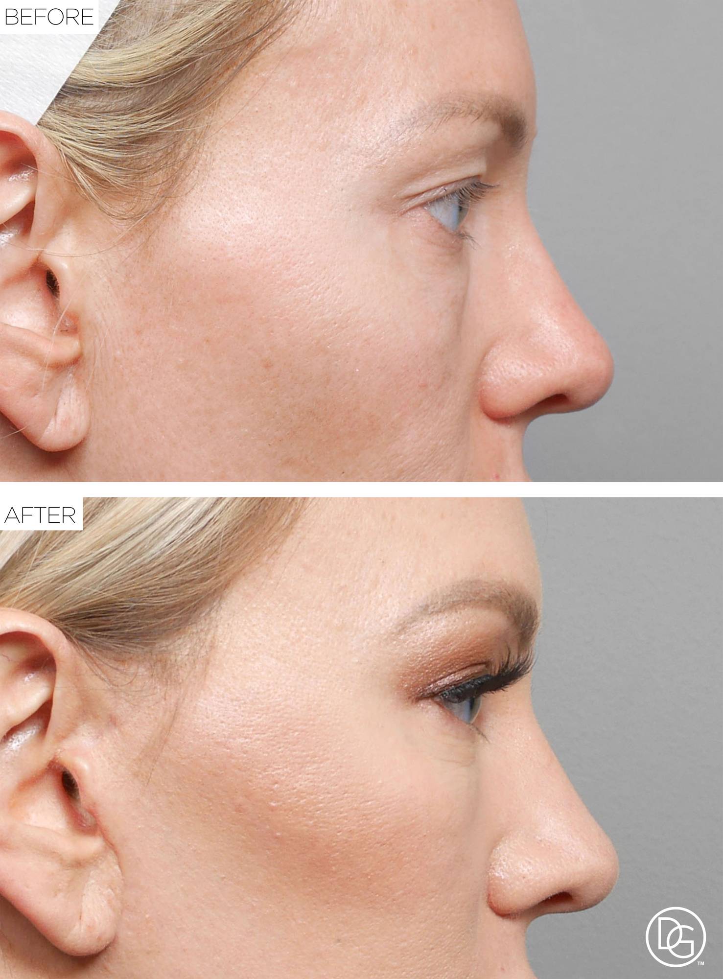 Blepharoplasty Before & After Image