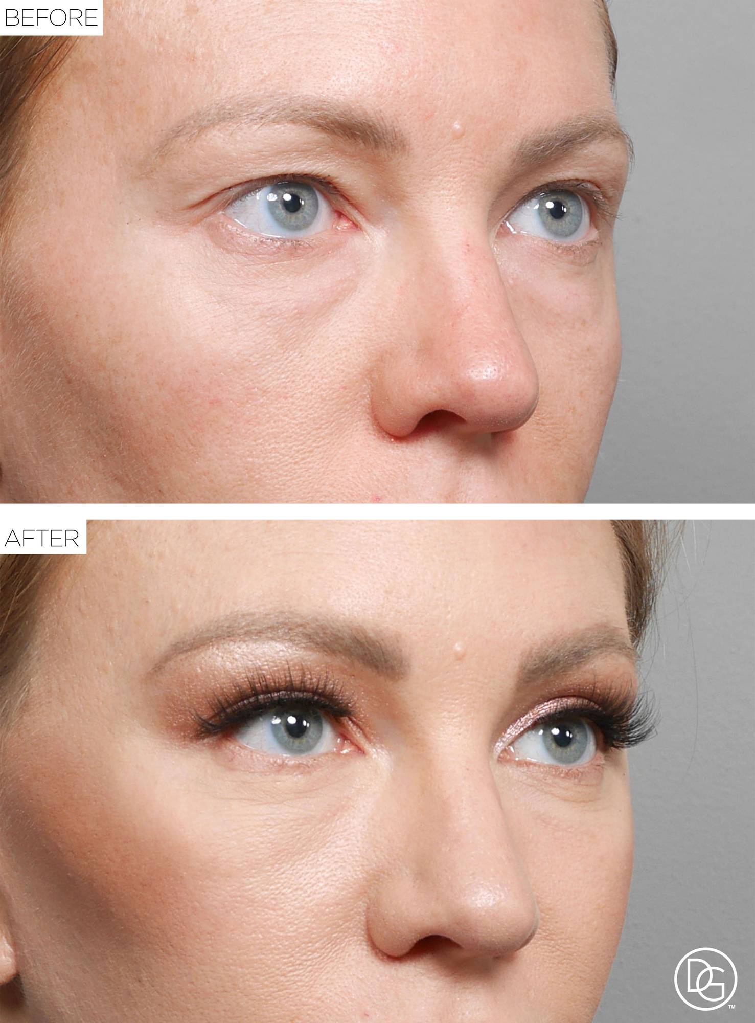 Blepharoplasty Before & After Image