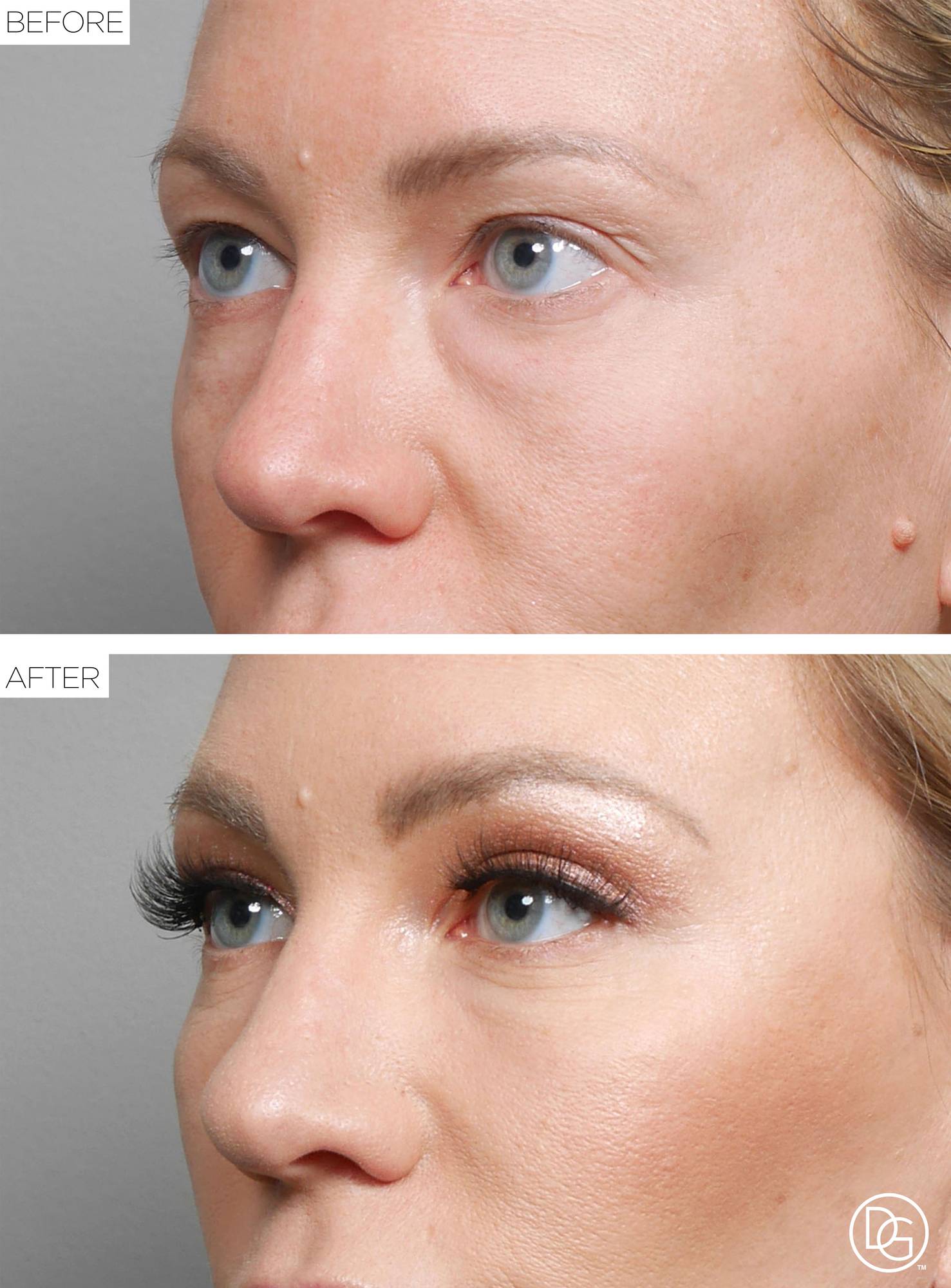 Blepharoplasty Before & After Image