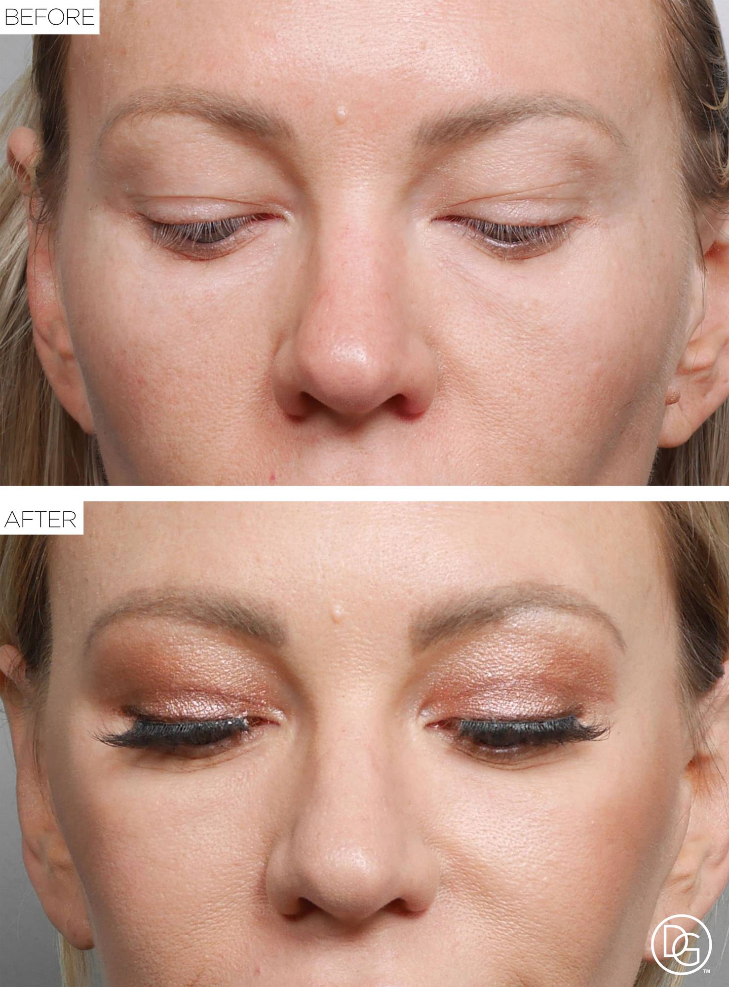 Blepharoplasty Before & After Image