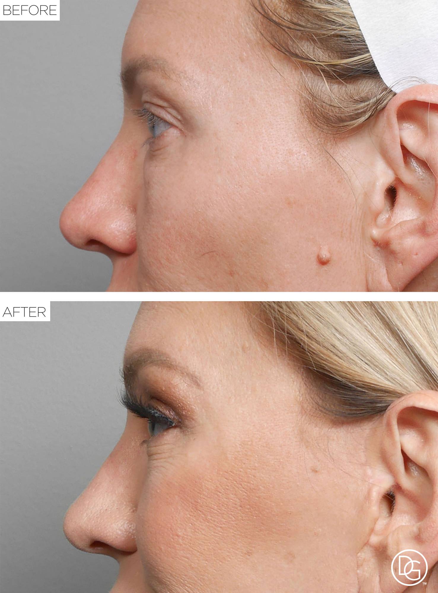 Blepharoplasty Before & After Image