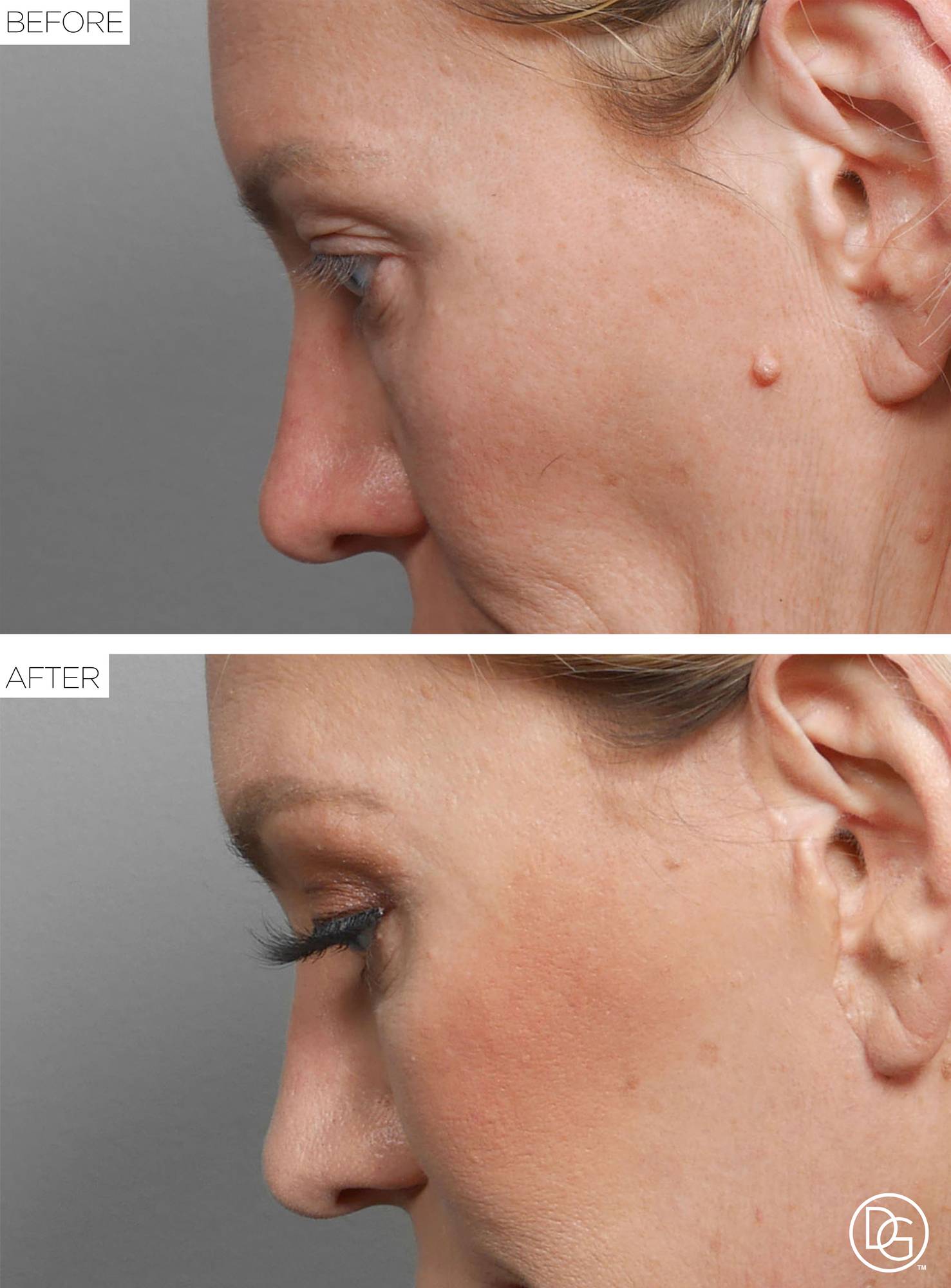 Blepharoplasty Before & After Image