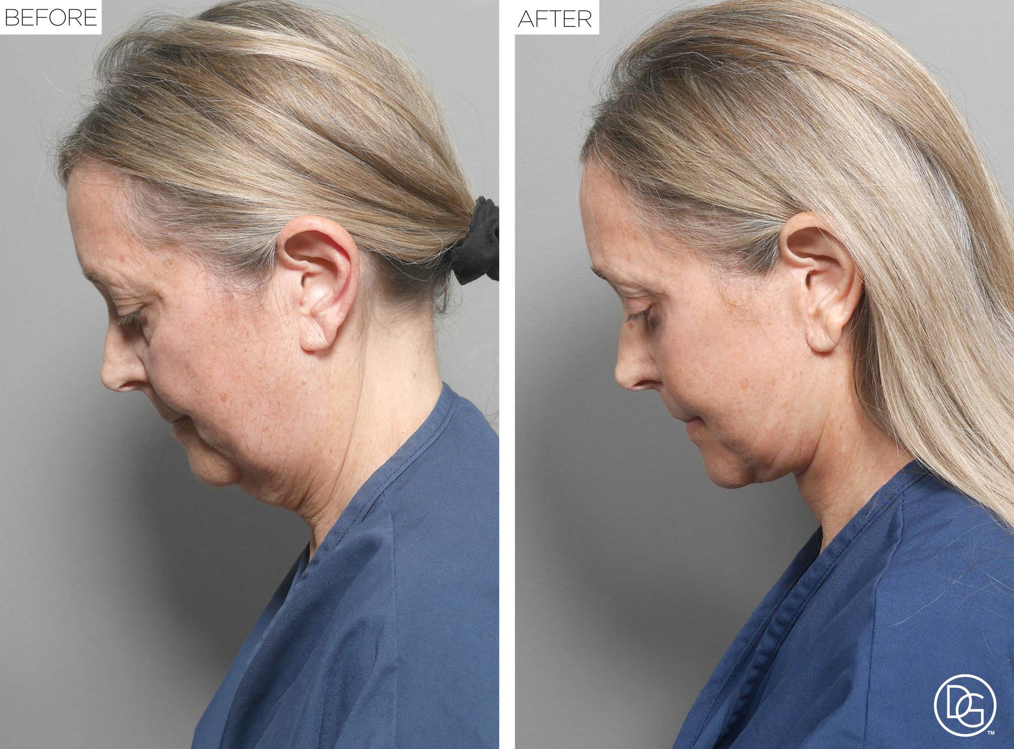Facelift Before & After Image