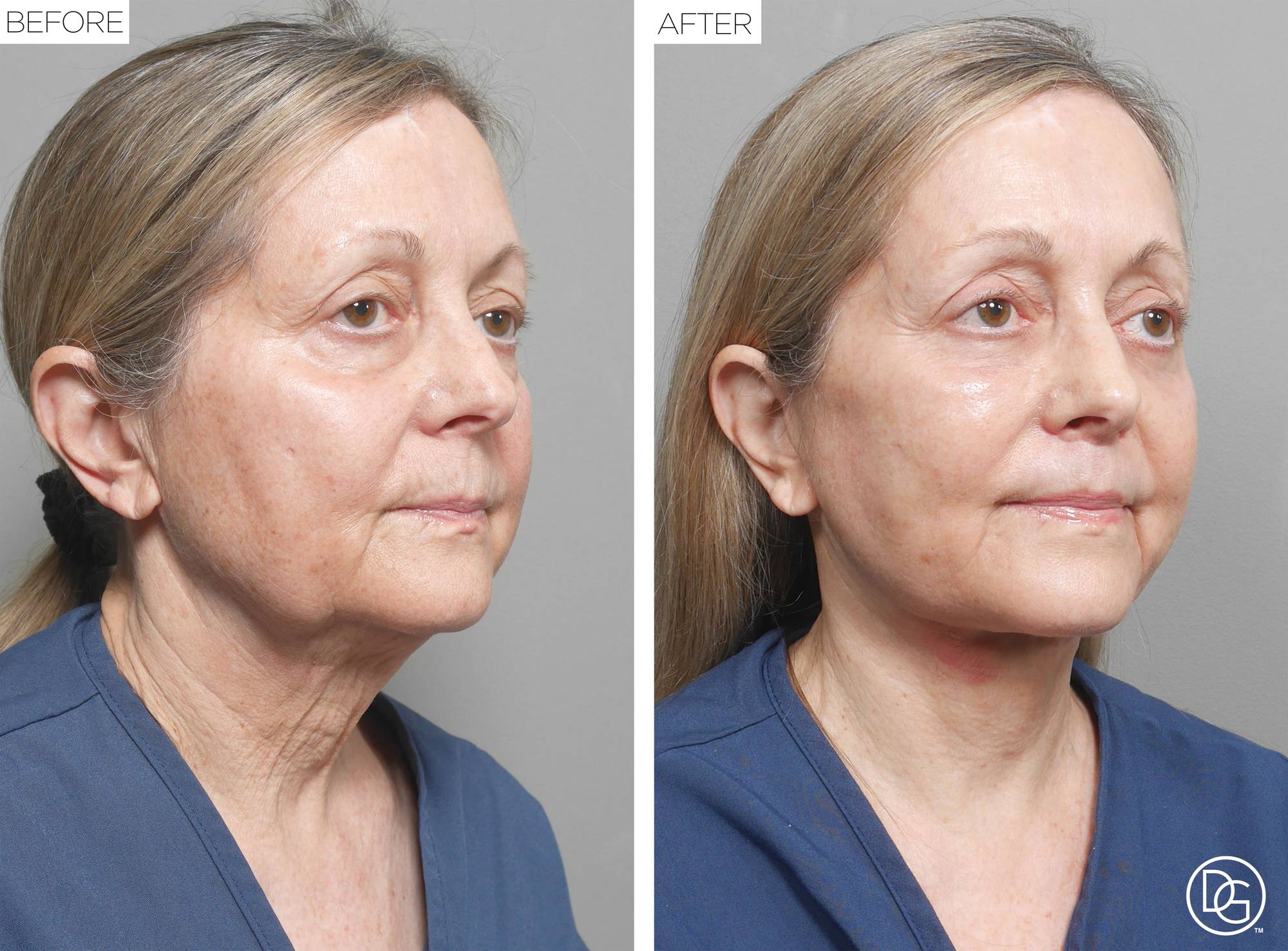 Facelift Before & After Image