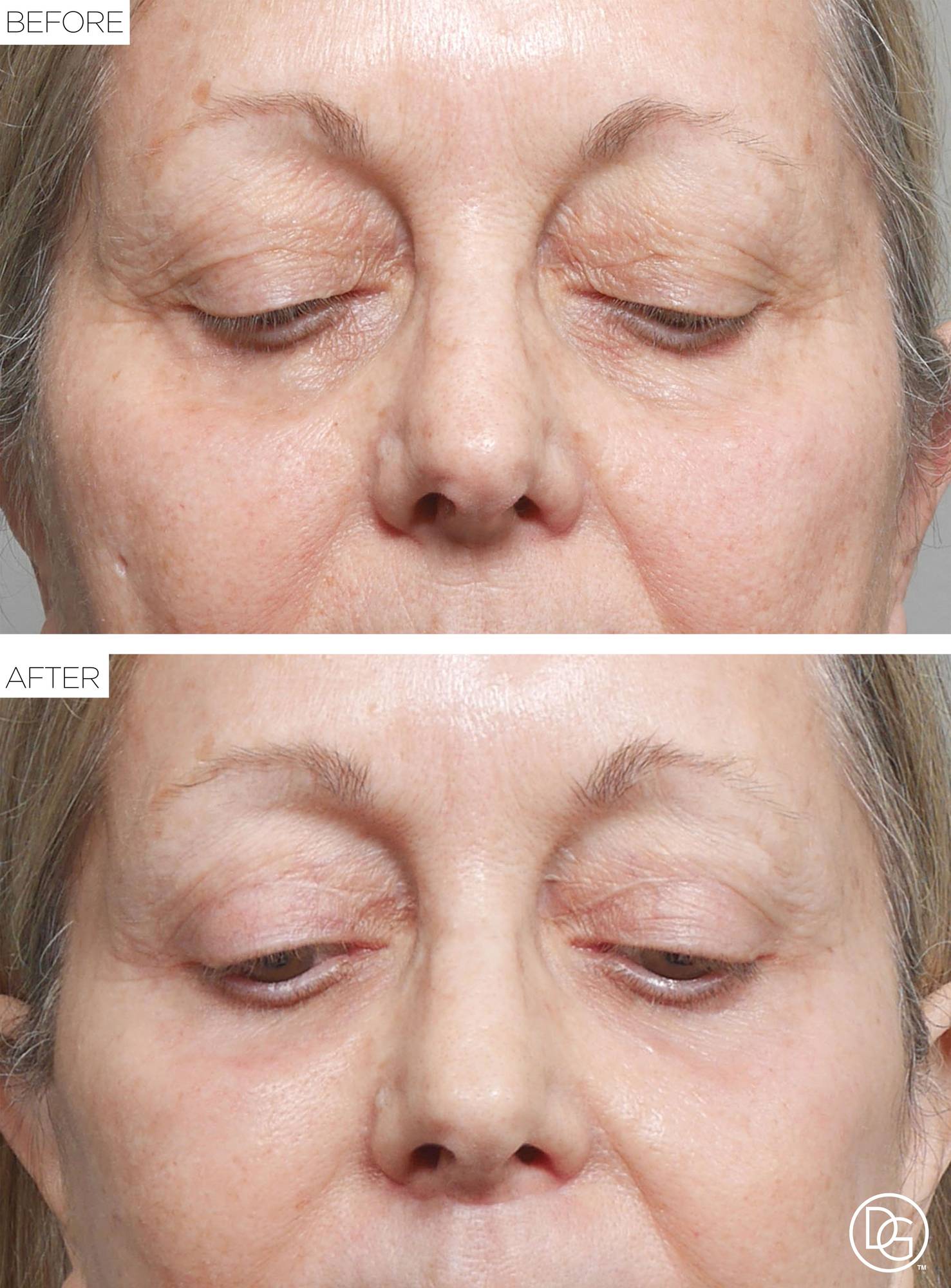 Blepharoplasty Before & After Image