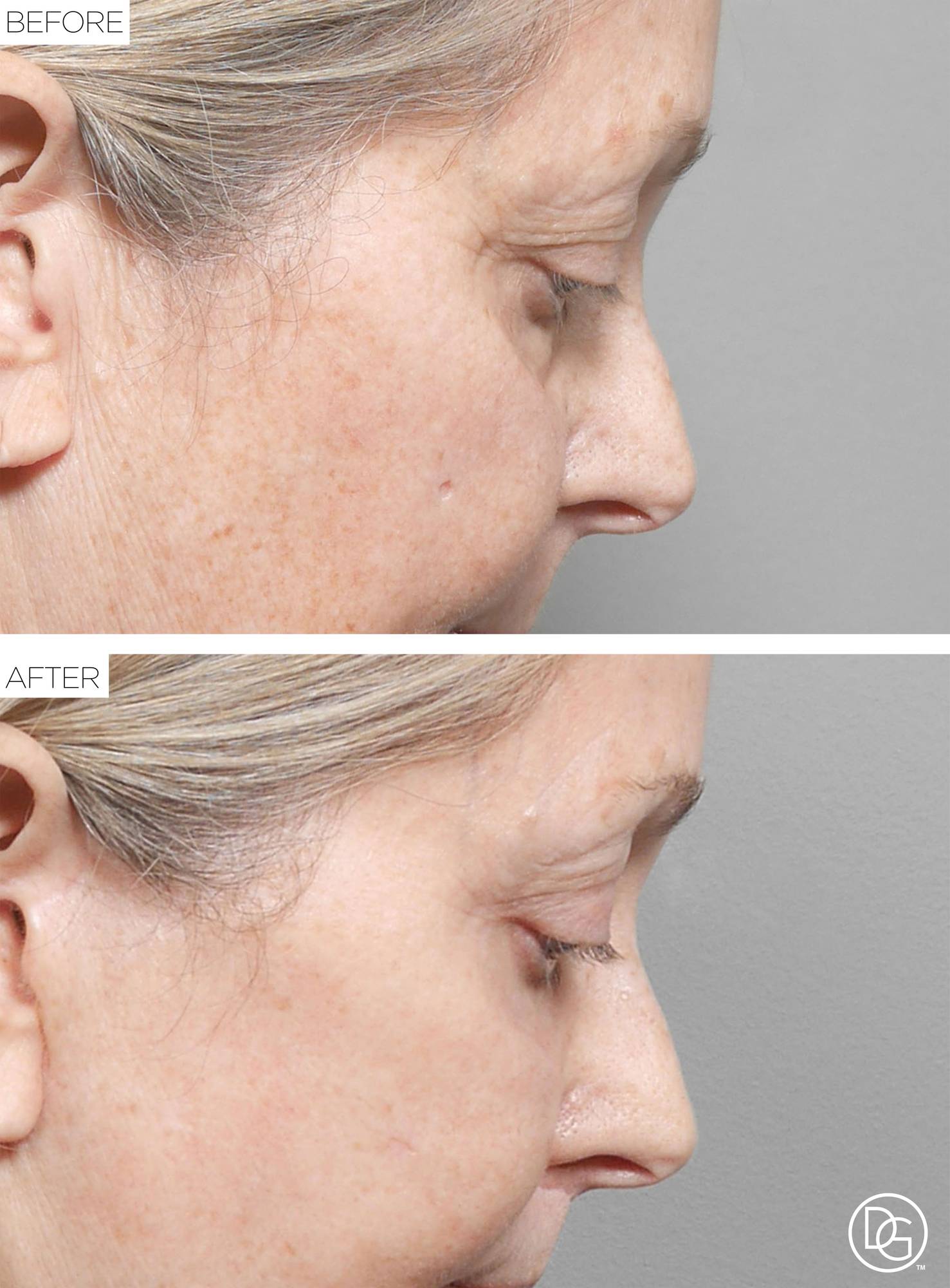 Blepharoplasty Before & After Image