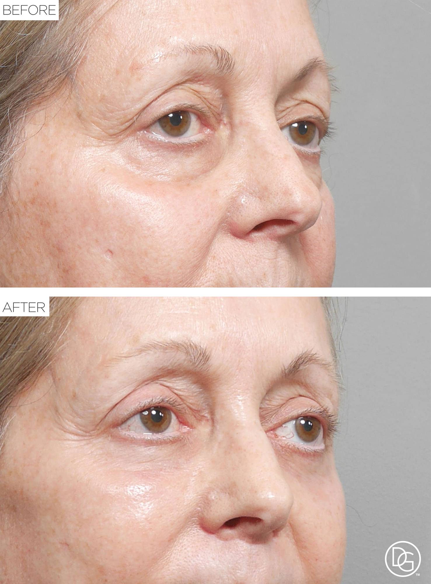 Blepharoplasty Before & After Image