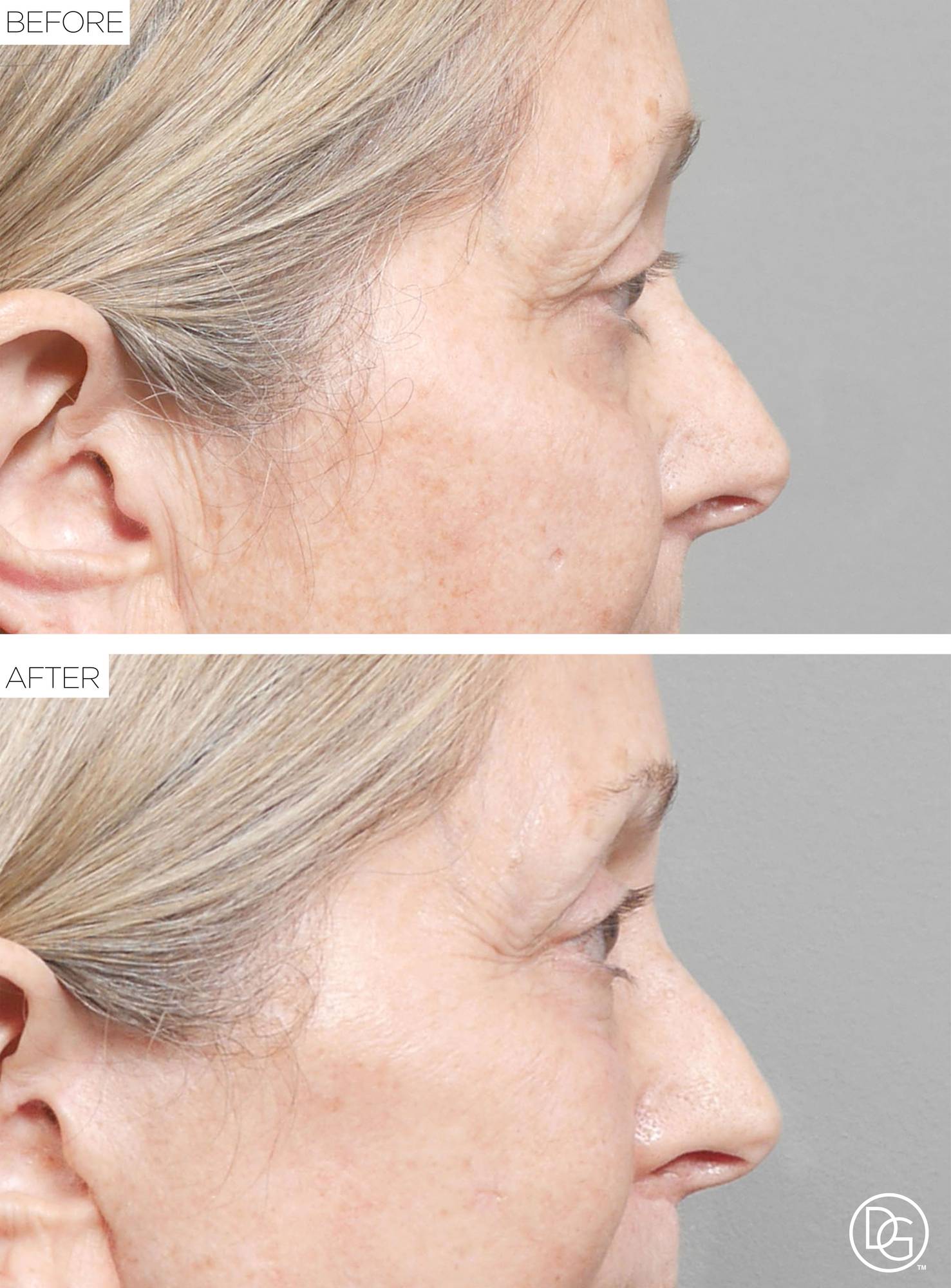 Blepharoplasty Before & After Image