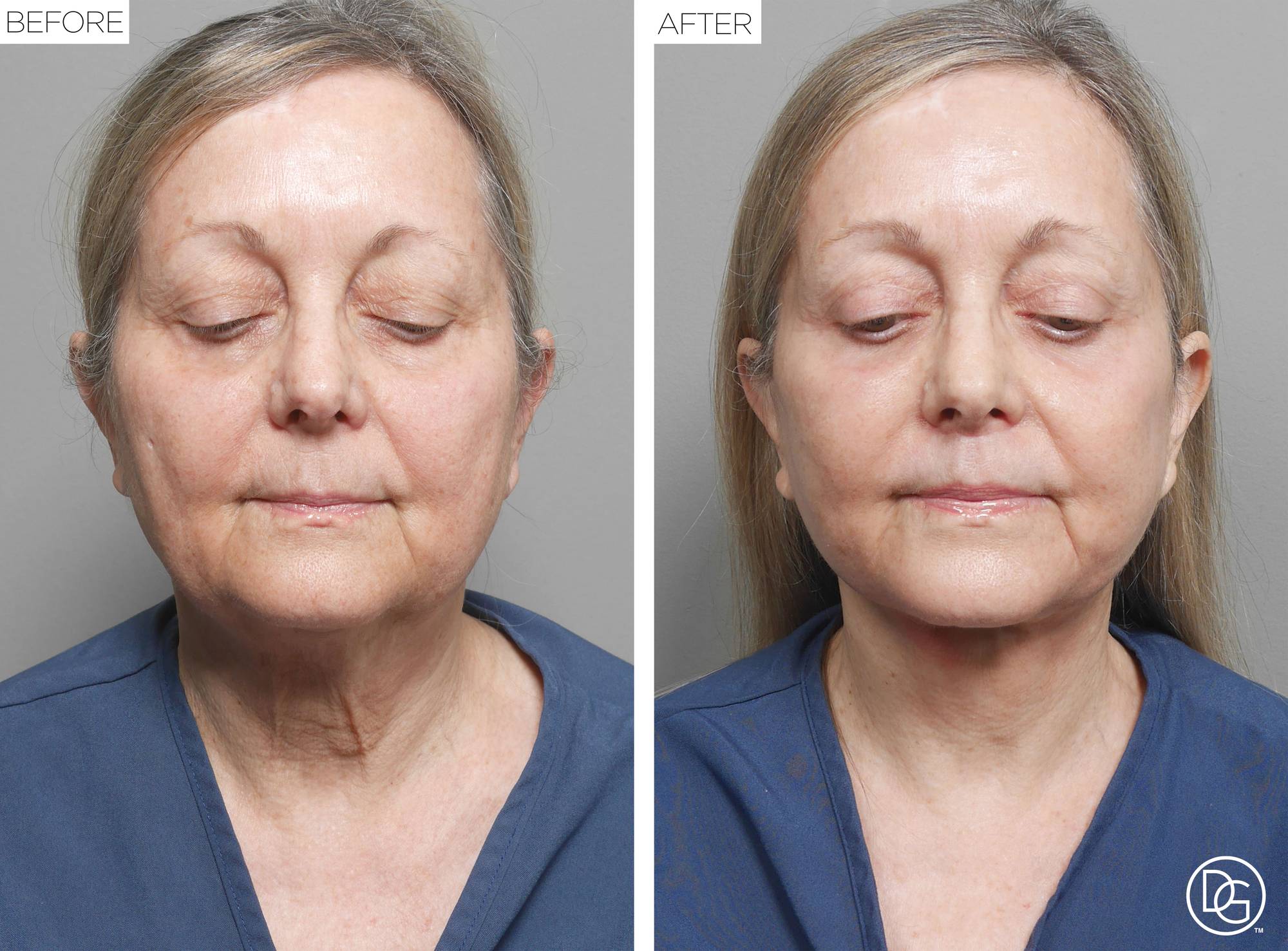 Facelift Before & After Image