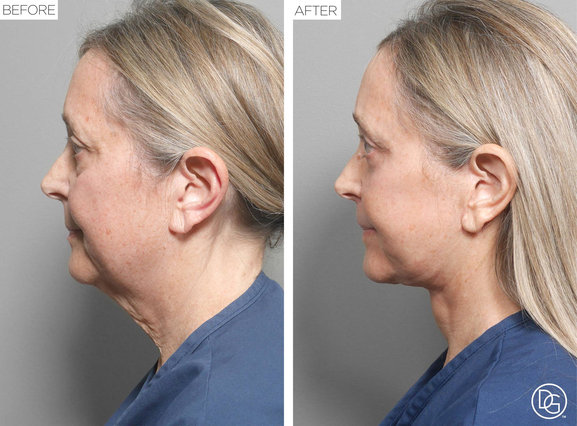Facelift Before & After Image