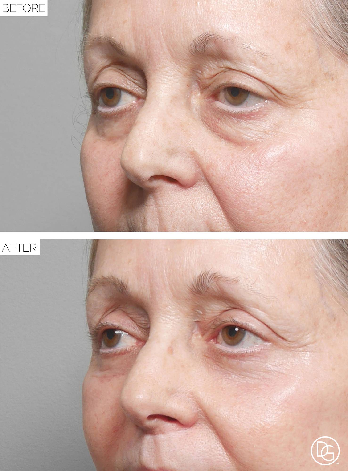 Blepharoplasty Before & After Image