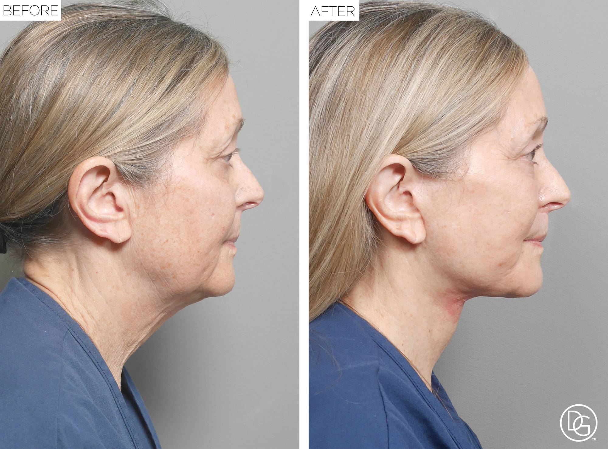 Facelift Before & After Image