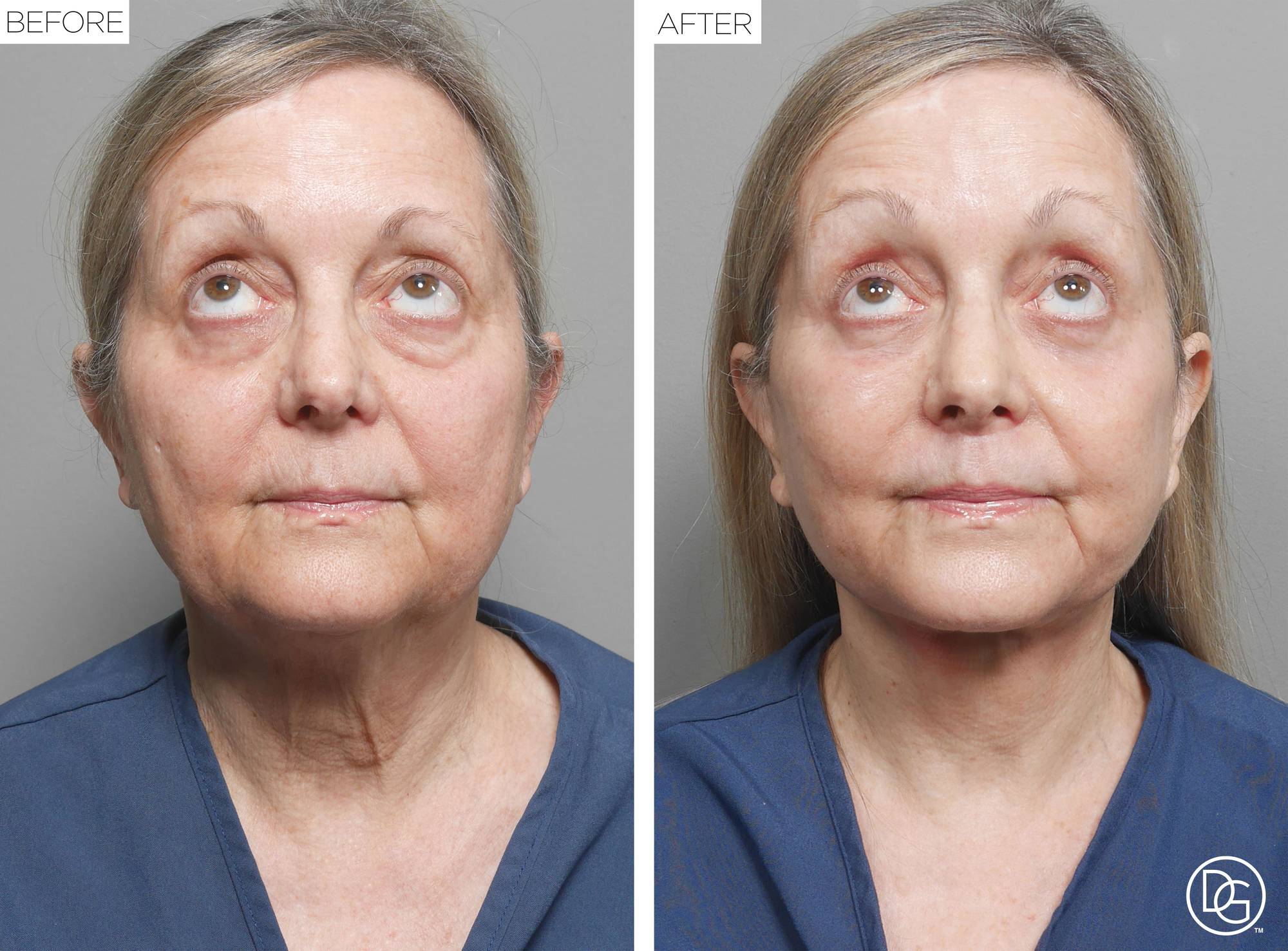 Facelift Before & After Image