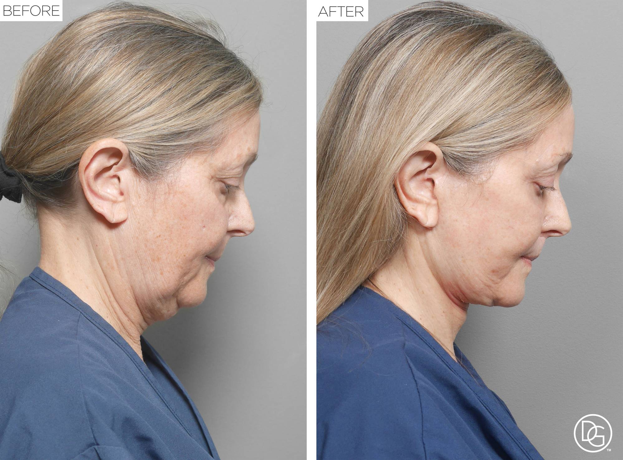 Facelift Before & After Image