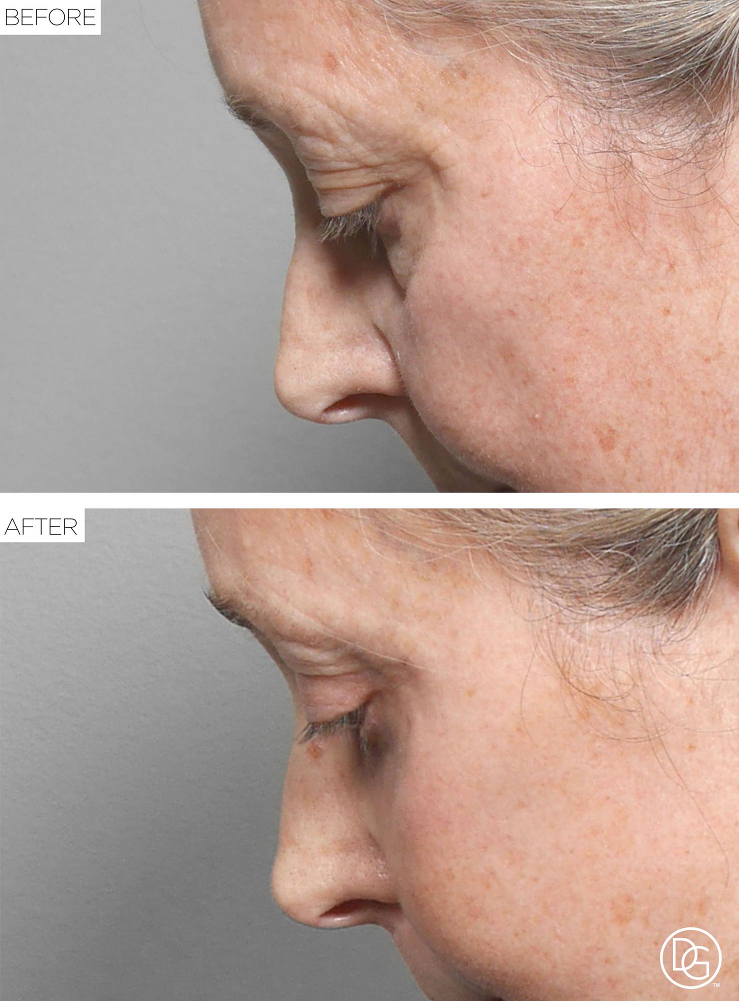 Blepharoplasty Before & After Image