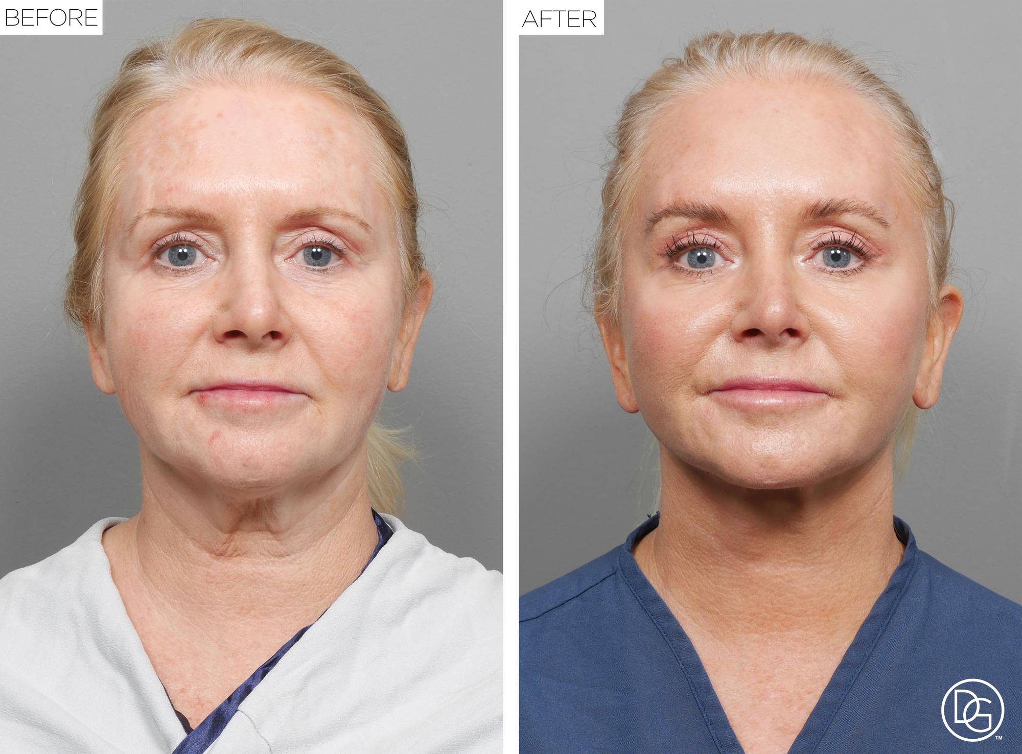 Facelift Before & After Image