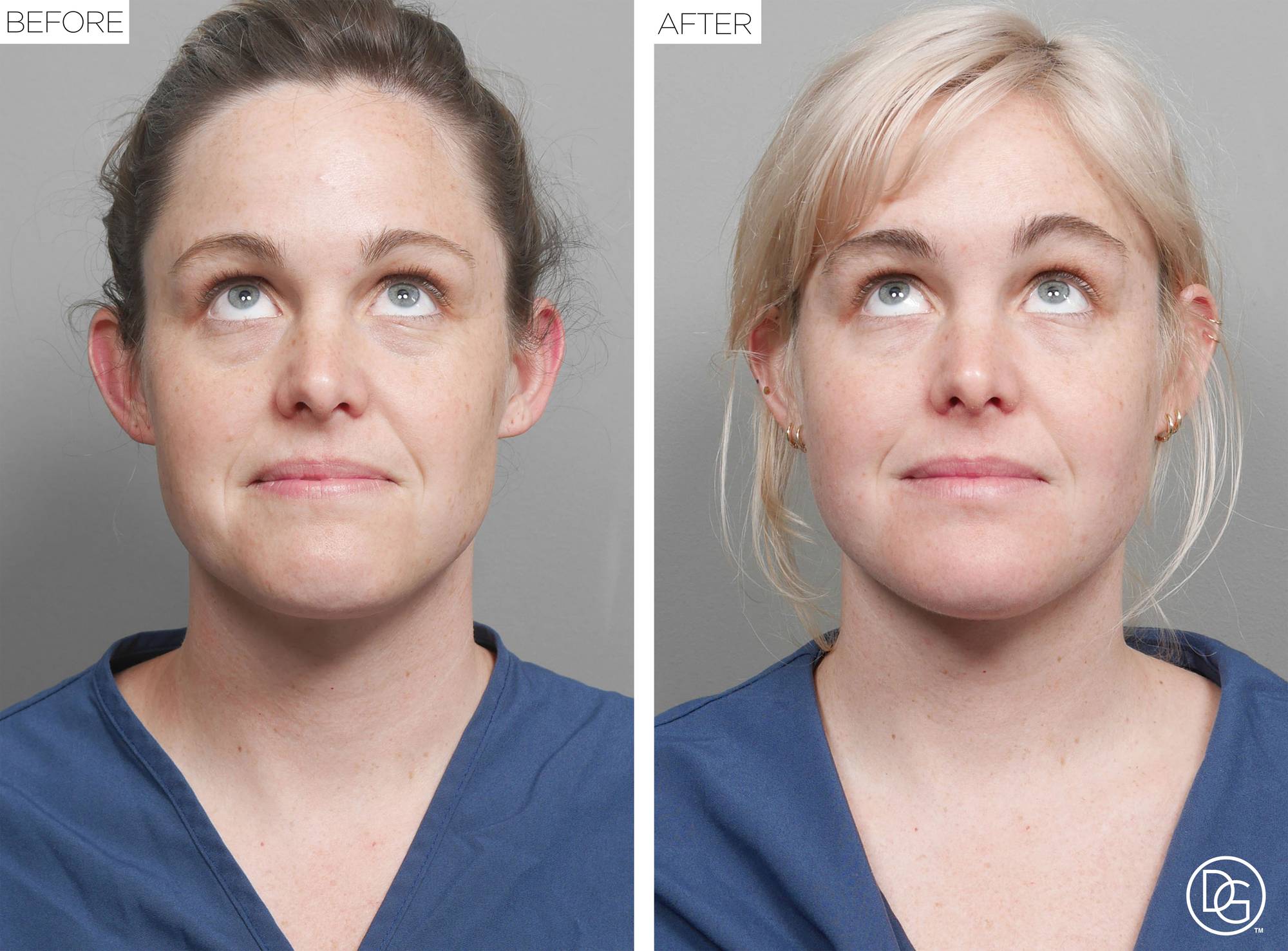 Weekend Lift Before & After Image