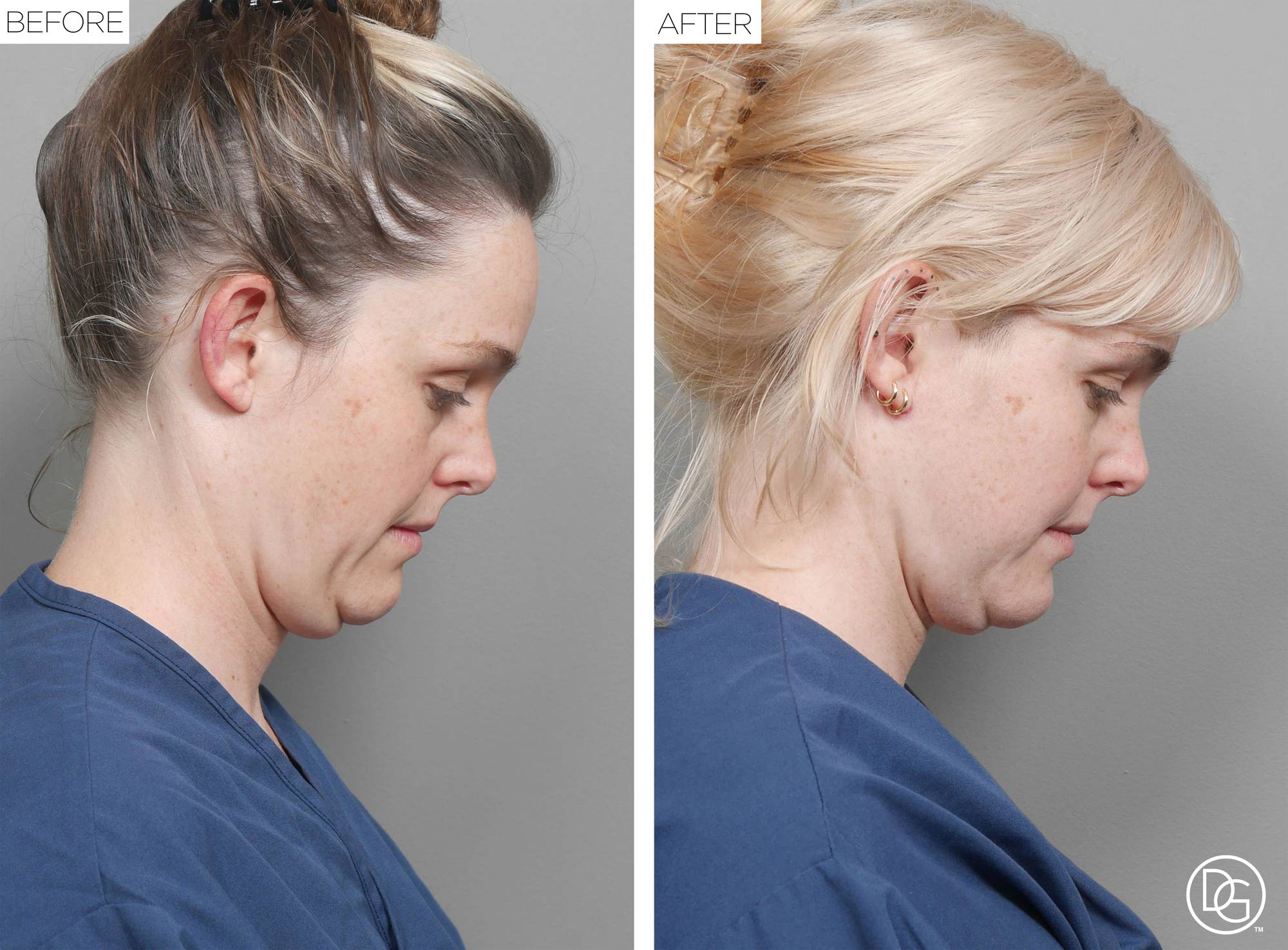 Weekend Lift Before & After Image