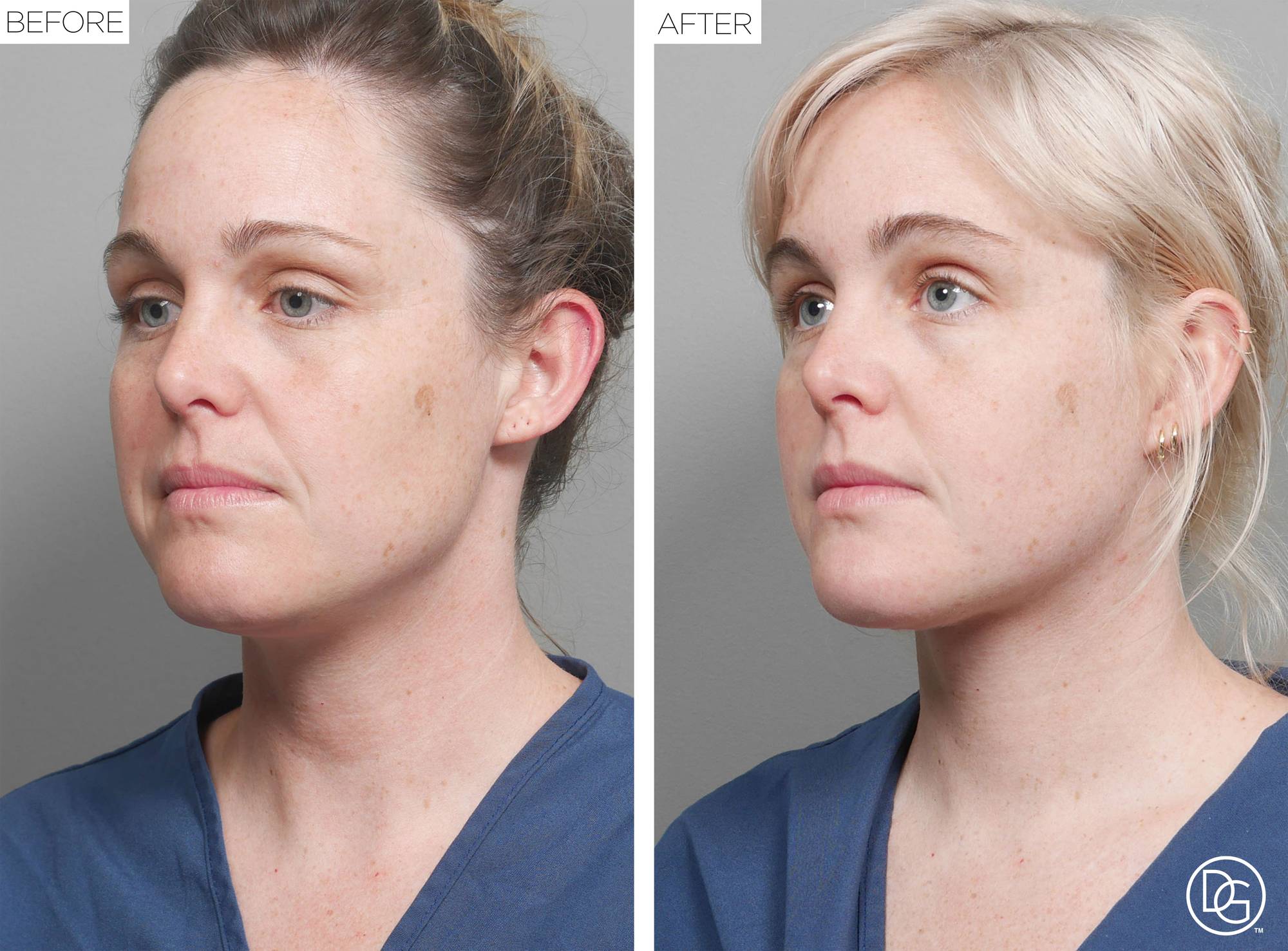 Weekend Lift Before & After Image